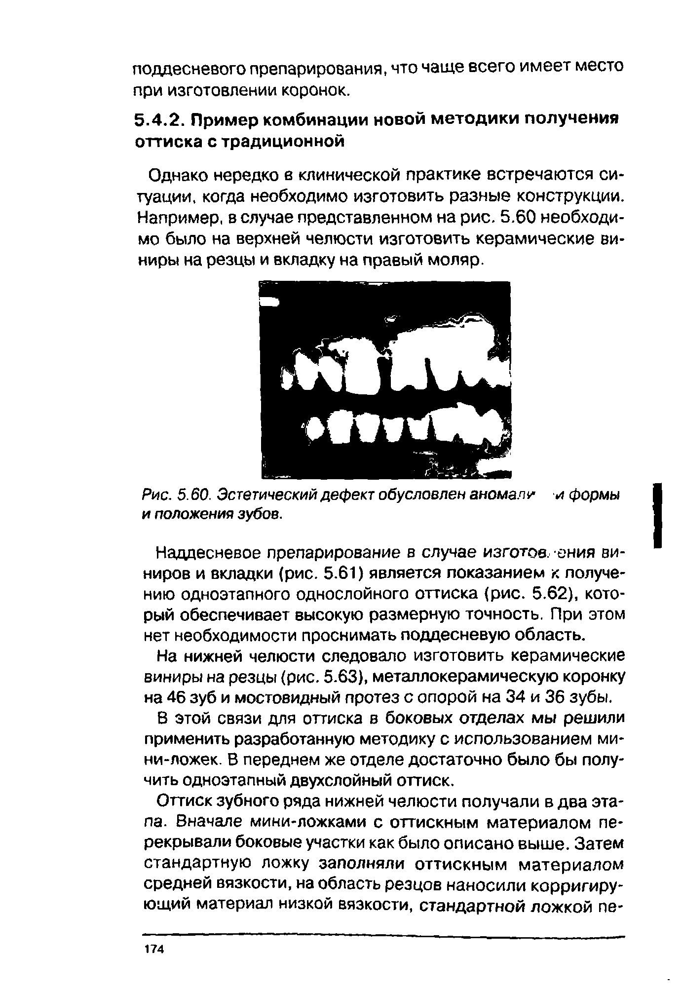 Рис. 5.60. Эстетический дефект обусловлен аномали и формы и положения зубов.