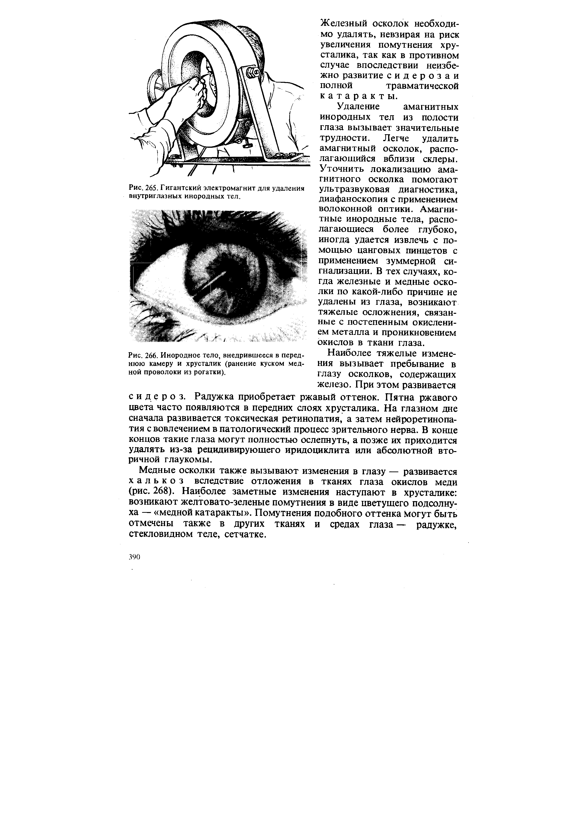 Рис. 266. Инородное тело, внедрившееся в переднюю камеру и хрусталик (ранение куском медной проволоки из рогатки).