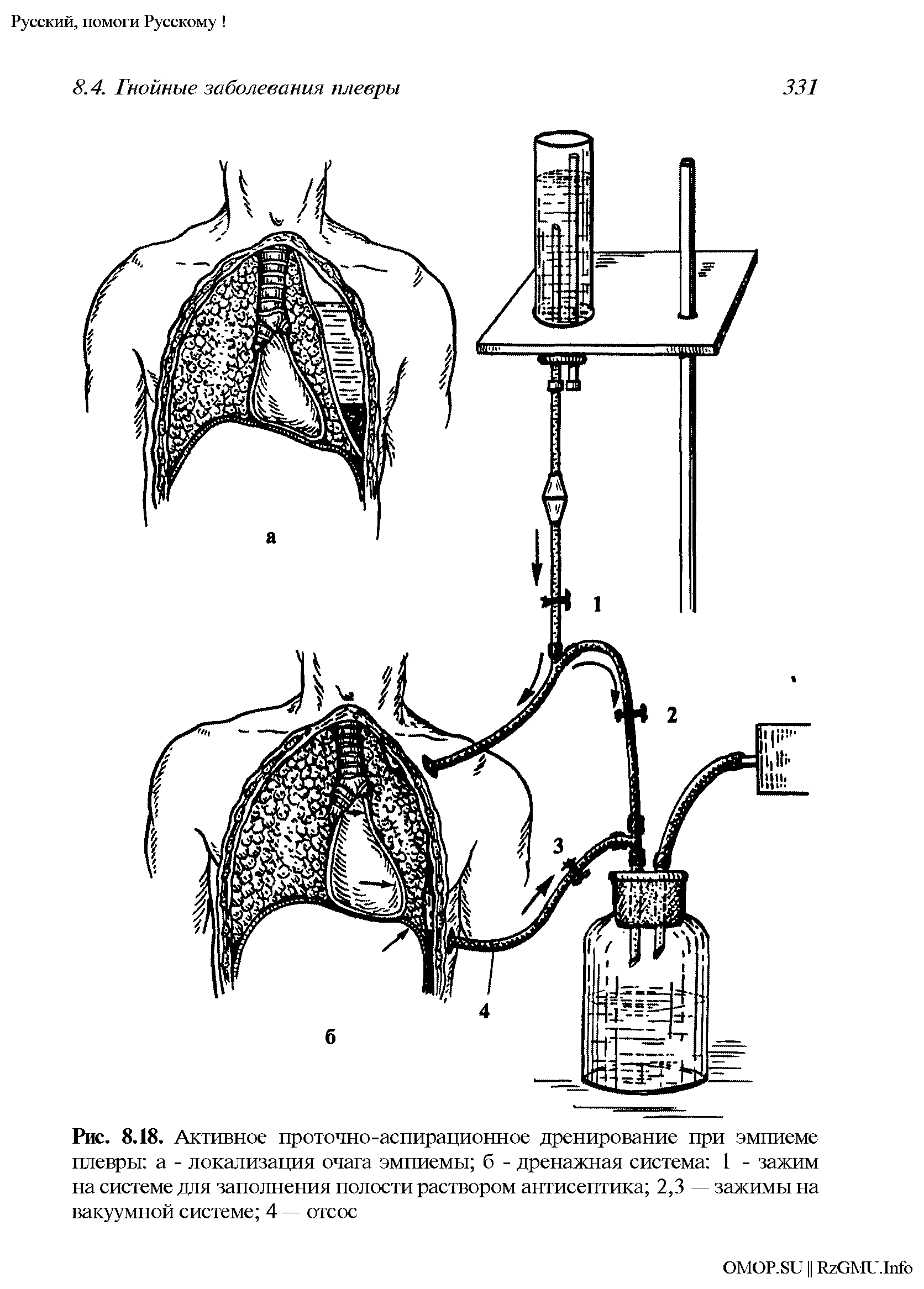 Рис. 8.18. Активное проточно-аспирационное дренирование при эмпиеме плевры а - локализация очага эмпиемы б - дренажная система I - зажим на системе для заполнения полости раствором антисептика 2,3 — зажимы на вакуумной системе 4 — отсос...