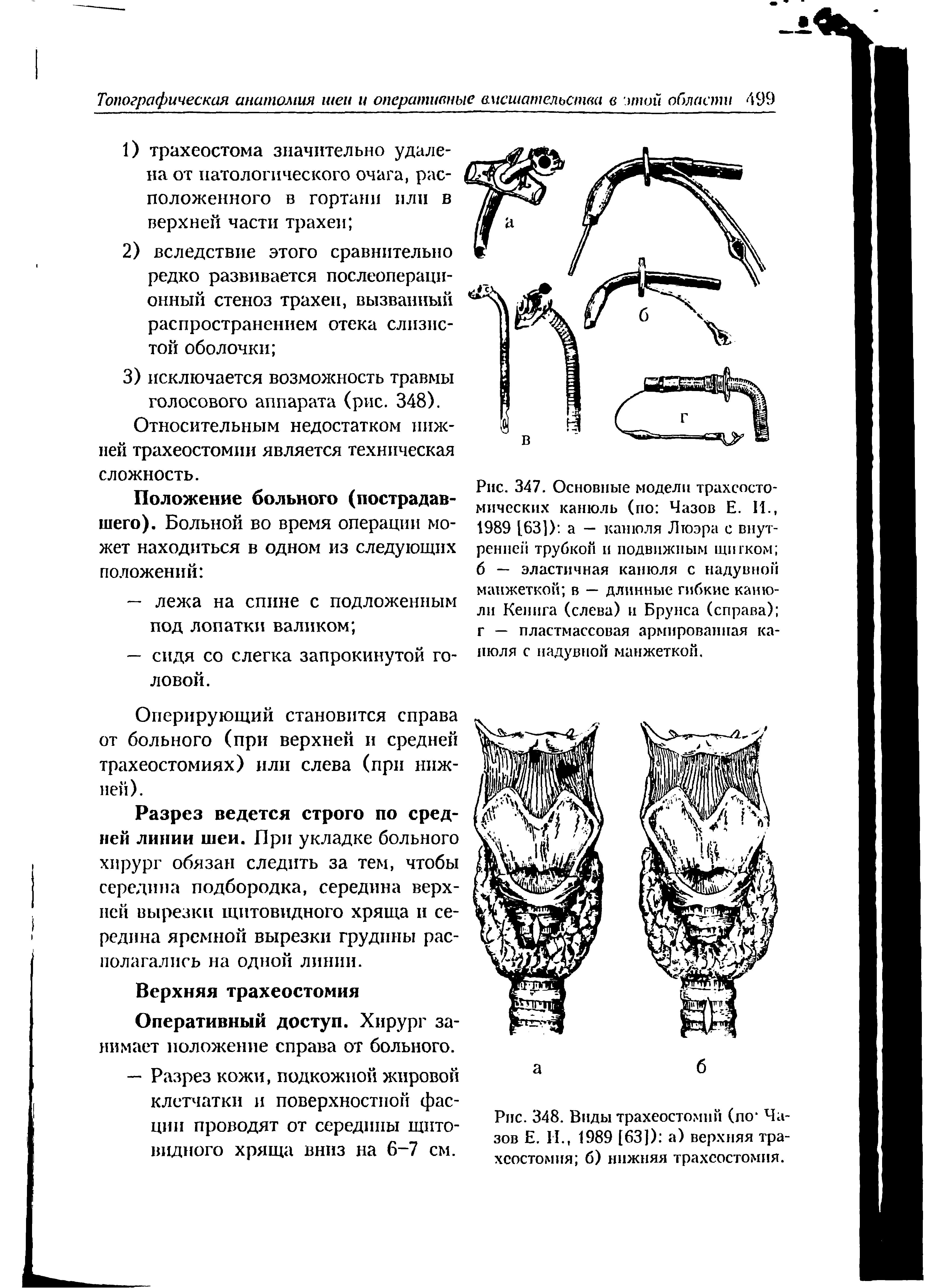 Рис. 348. Виды трахеостомий (по Чазов Е. И., 1989 [63]) а) верхняя трахеостомия б) нижняя трахеостомия.