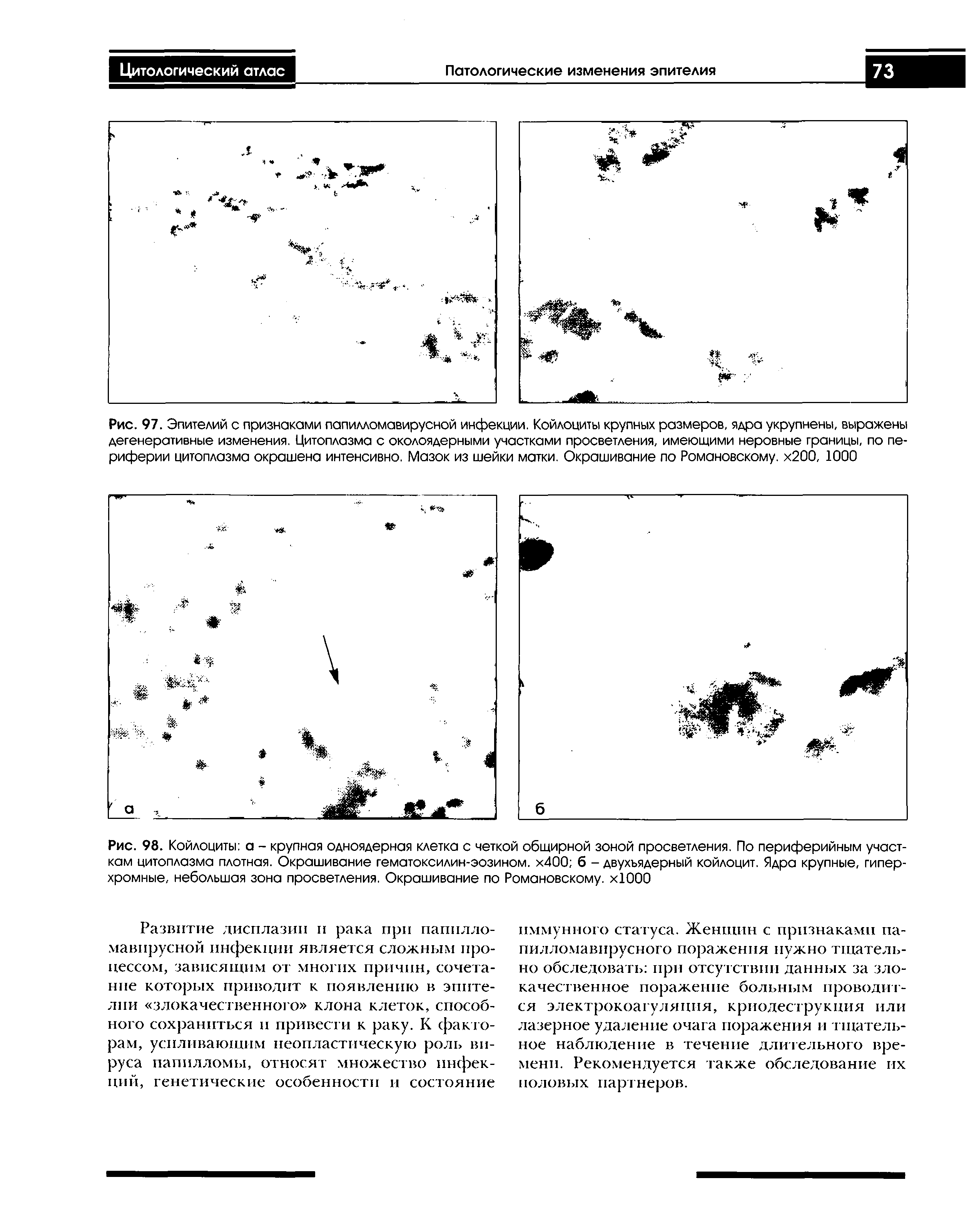 Рис. 98. Койлоциты а - крупная одноядерная клетка с четкой обширной зоной просветления. По периферийным участкам цитоплазма плотная. Окрашивание гематоксилин-эозином. х400 б - двухъядерный койлоцит. Ядра крупные, гипер-хромные, небольшая зона просветления. Окрашивание по Романовскому. хЮОО...
