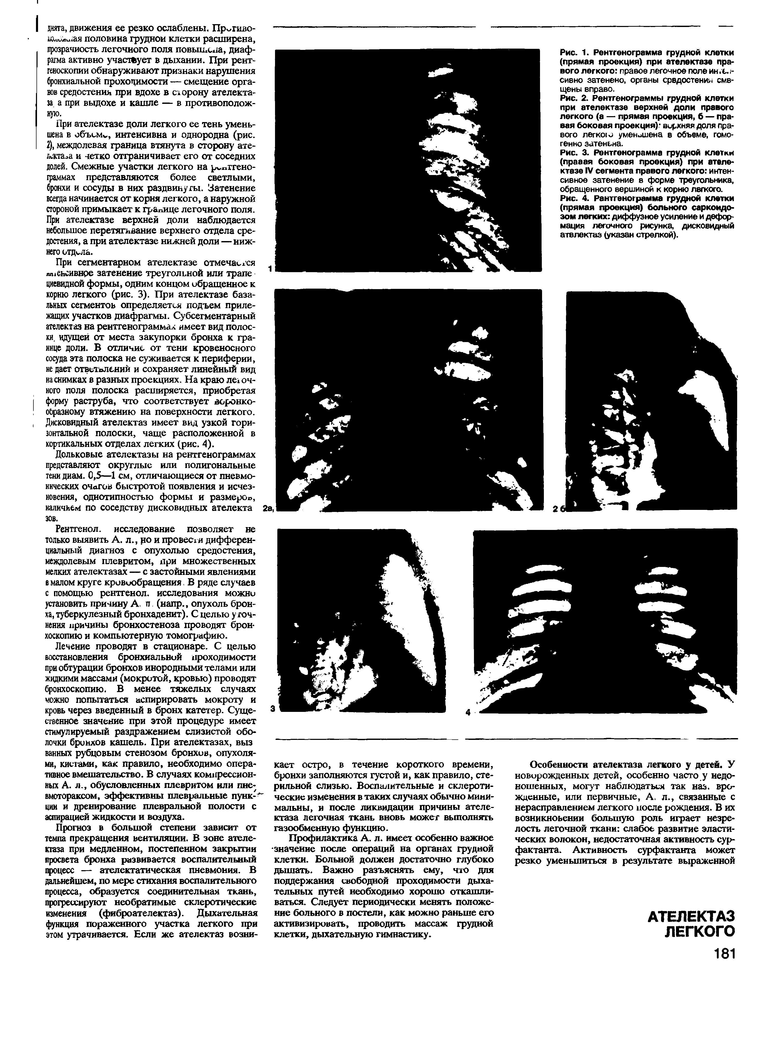 Рис. 3. Рентгенограмма грудной клетки (правая боковая проекция) при ателектазе IV сегмента правого легкого интенсивное затенение в форме треугольника, обращенного вершиной к корню легкого.