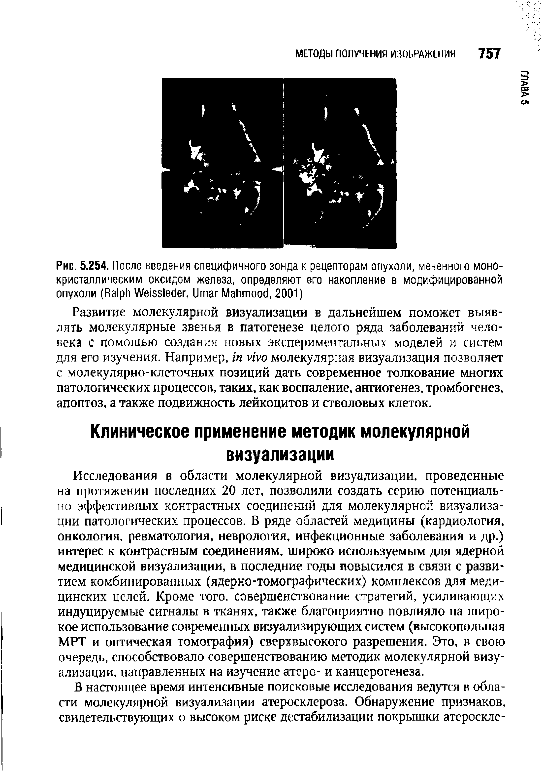 Рис. 5.254. После введения специфичного зонда к рецепторам опухоли, меченного монокристаллическим оксидом железа, определяют его накопление в модифицированной опухоли (R W , U M , 2001)...