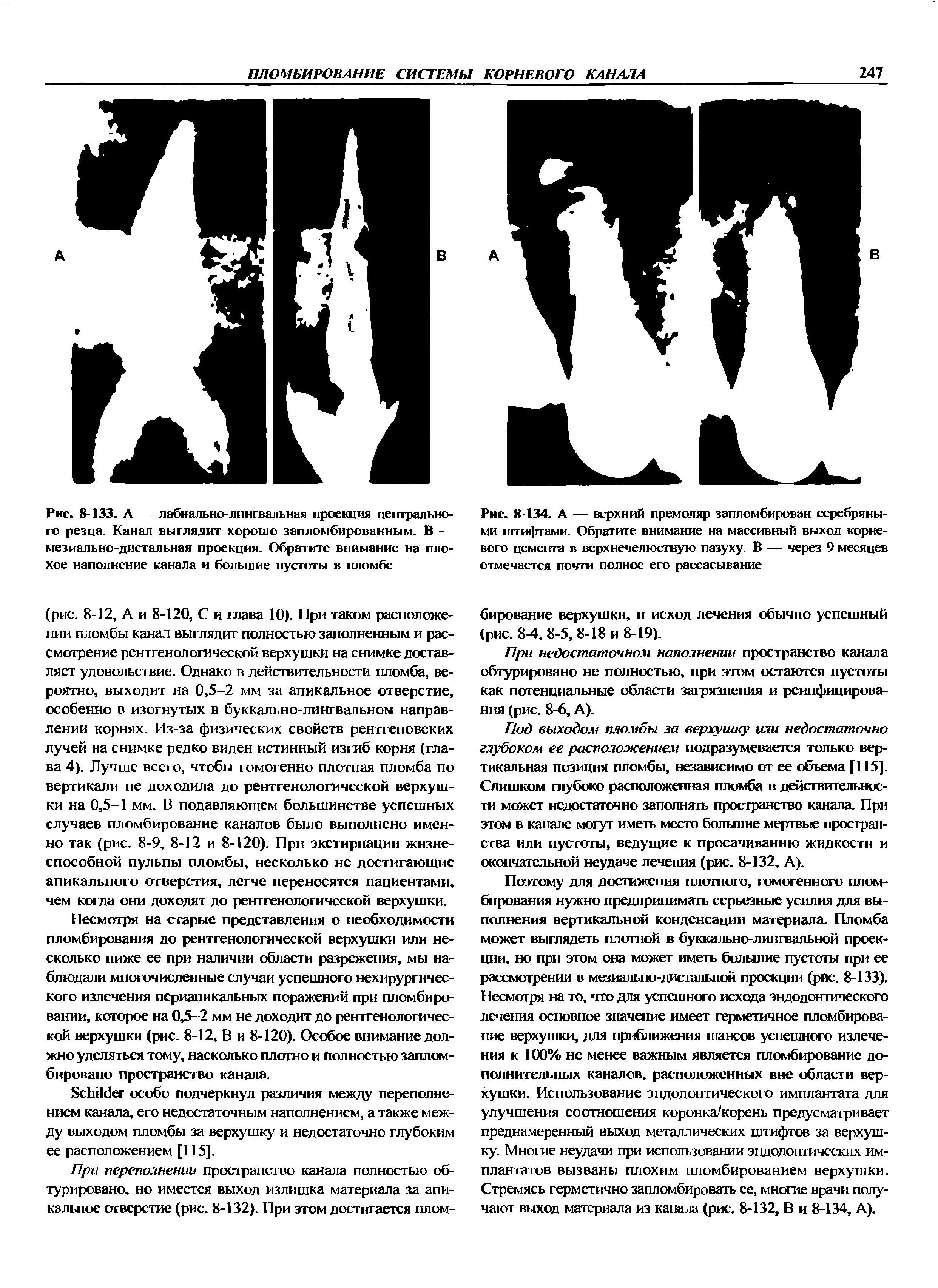 Рис. 8-133. А — лабиально-лингвальная проекция центрального резца. Канал выглядит хорошо запломбированным. В -мезиально-дистальная проекция. Обратите внимание на плохое наполнение канала и большие пустоты в пломбе...