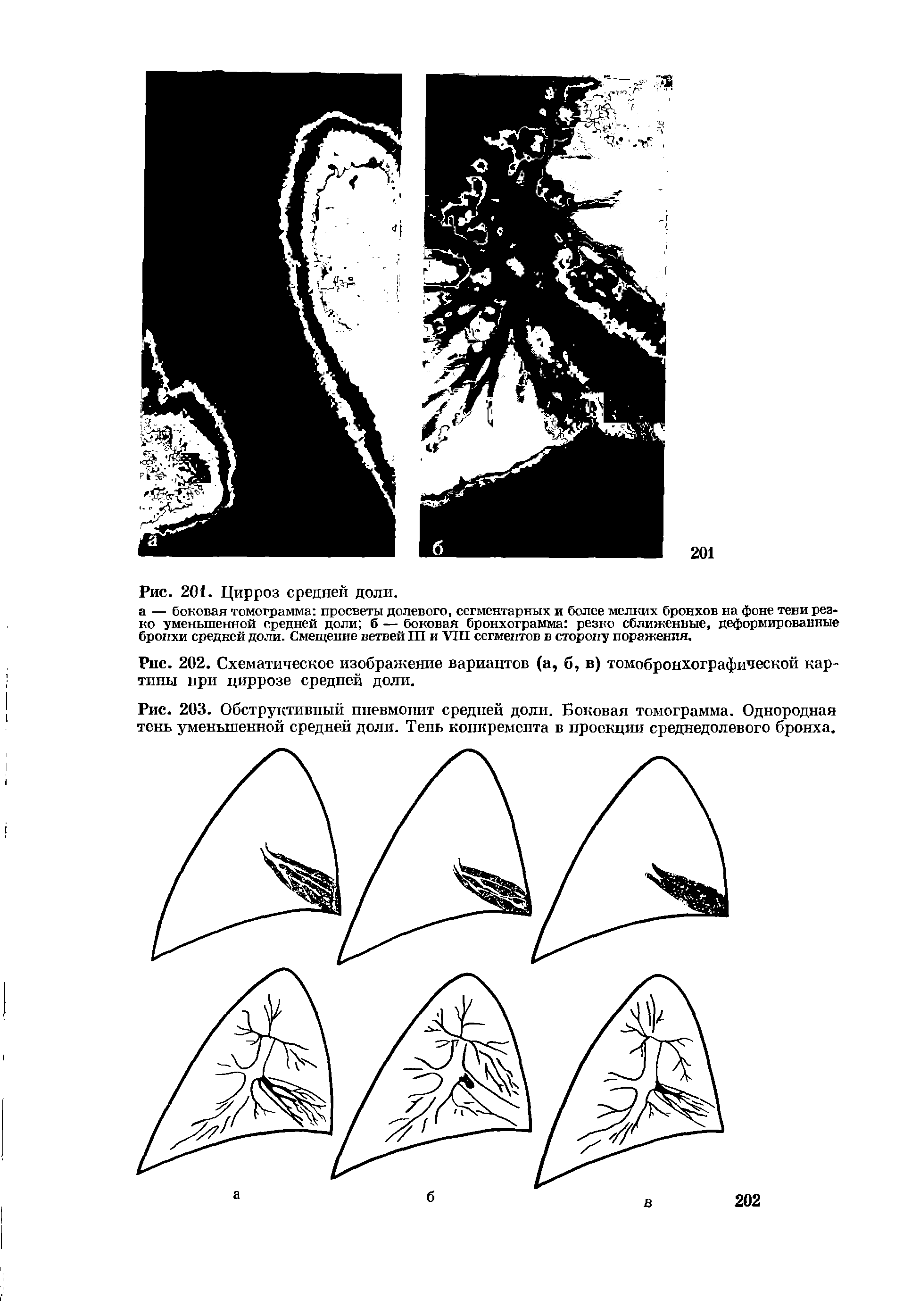 Рис. 203. Обструктивный пневмонит средней доли. Боковая томограмма. Однородная тень уменьшенной средней доли. Тень конкремента в проекции среднедолевого бронха.