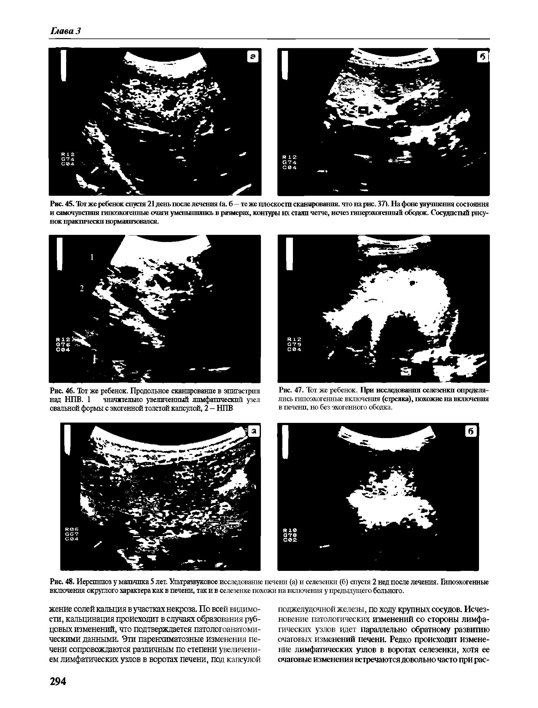 Рис. 48. Иерспнпоз у мальчика 5 лет. Ультразвуковое исследование печени (а) и селезенки (б) спустя 2 нед после лечения. Гипоэхогенные включения округлого характера как в печени, так и в селезенке похожи на включения у предыдущего больного.