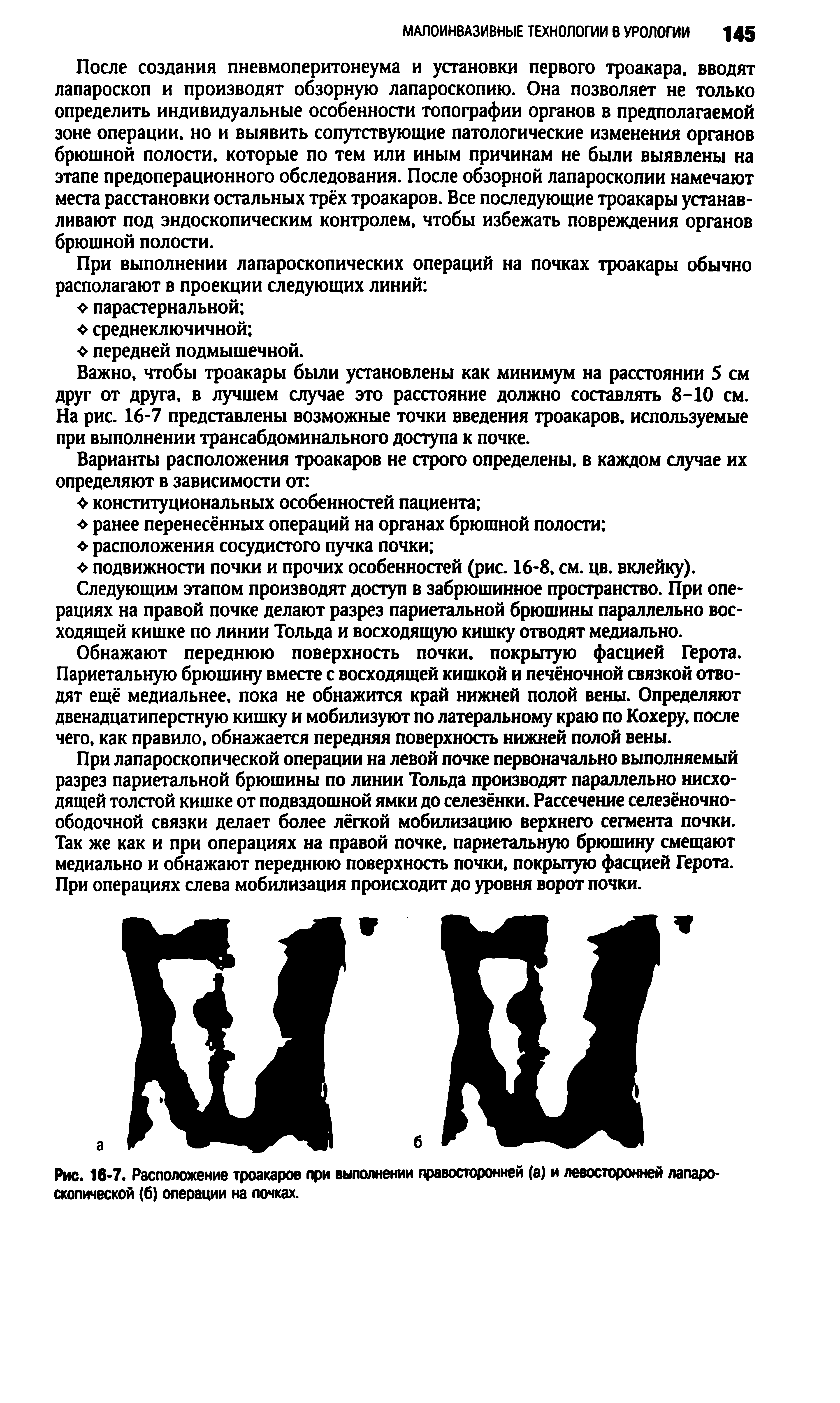 Рис. 16-7. Расположение троакаров при выполнении правосторонней (а) и левосторонней лапароскопической (6) операции на почках.