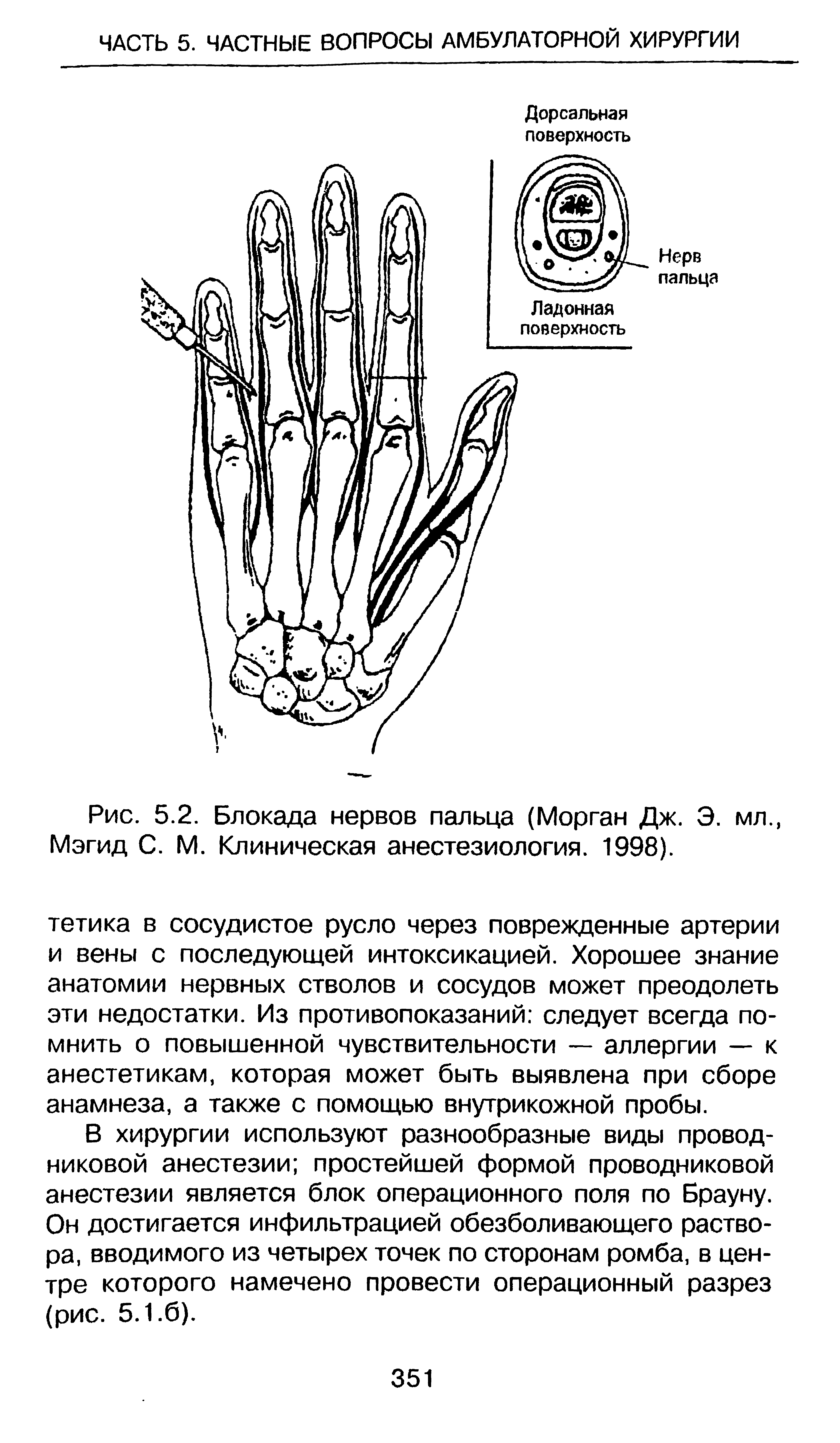 Рис. 5.2. Блокада нервов пальца (Морган Дж. Э. мл., Мэгид С. М. Клиническая анестезиология. 1998).