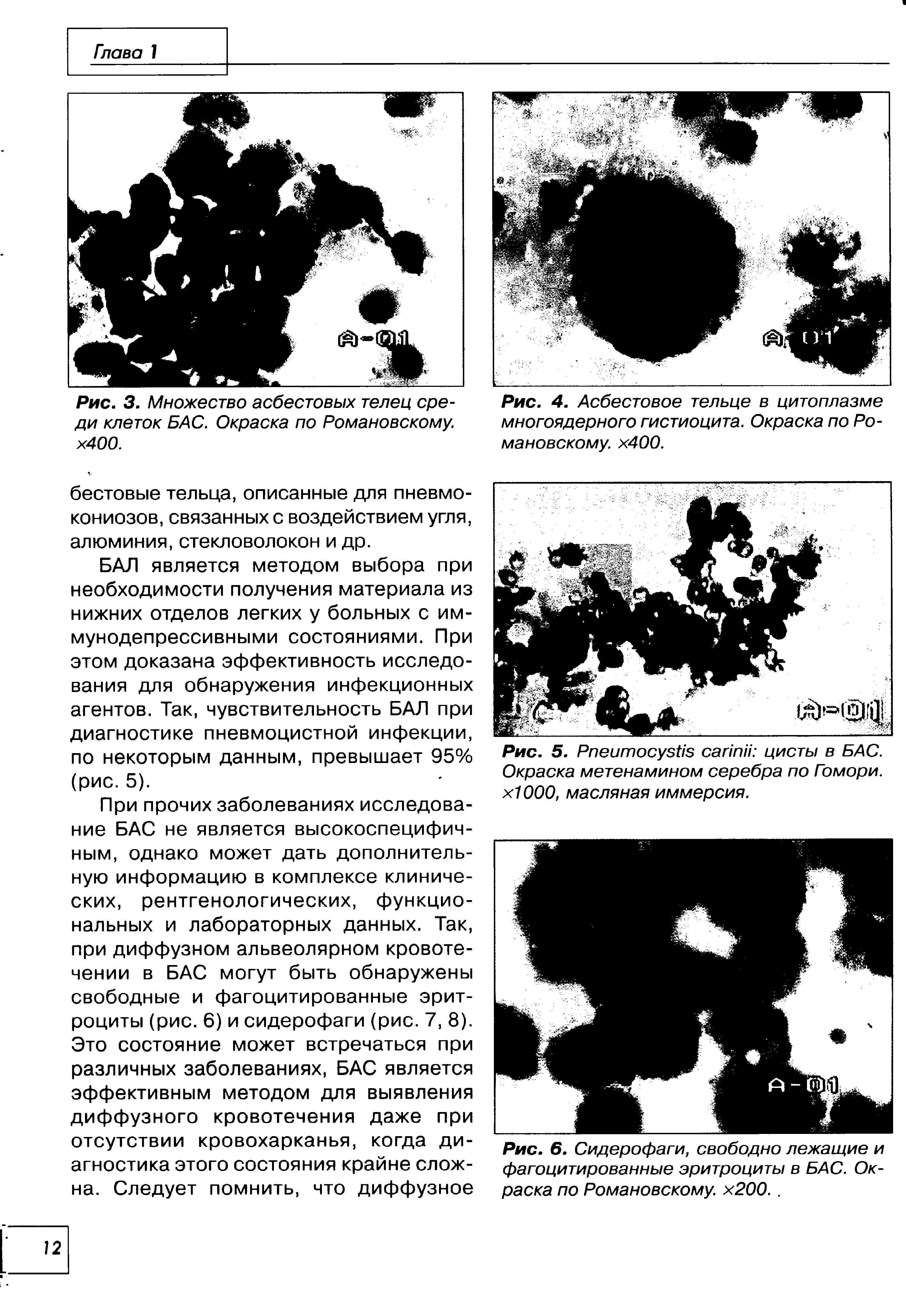 Рис. 4. Асбестовое тельце в цитоплазме многоядерного гистиоцита. Окраска по Романовскому. х400.