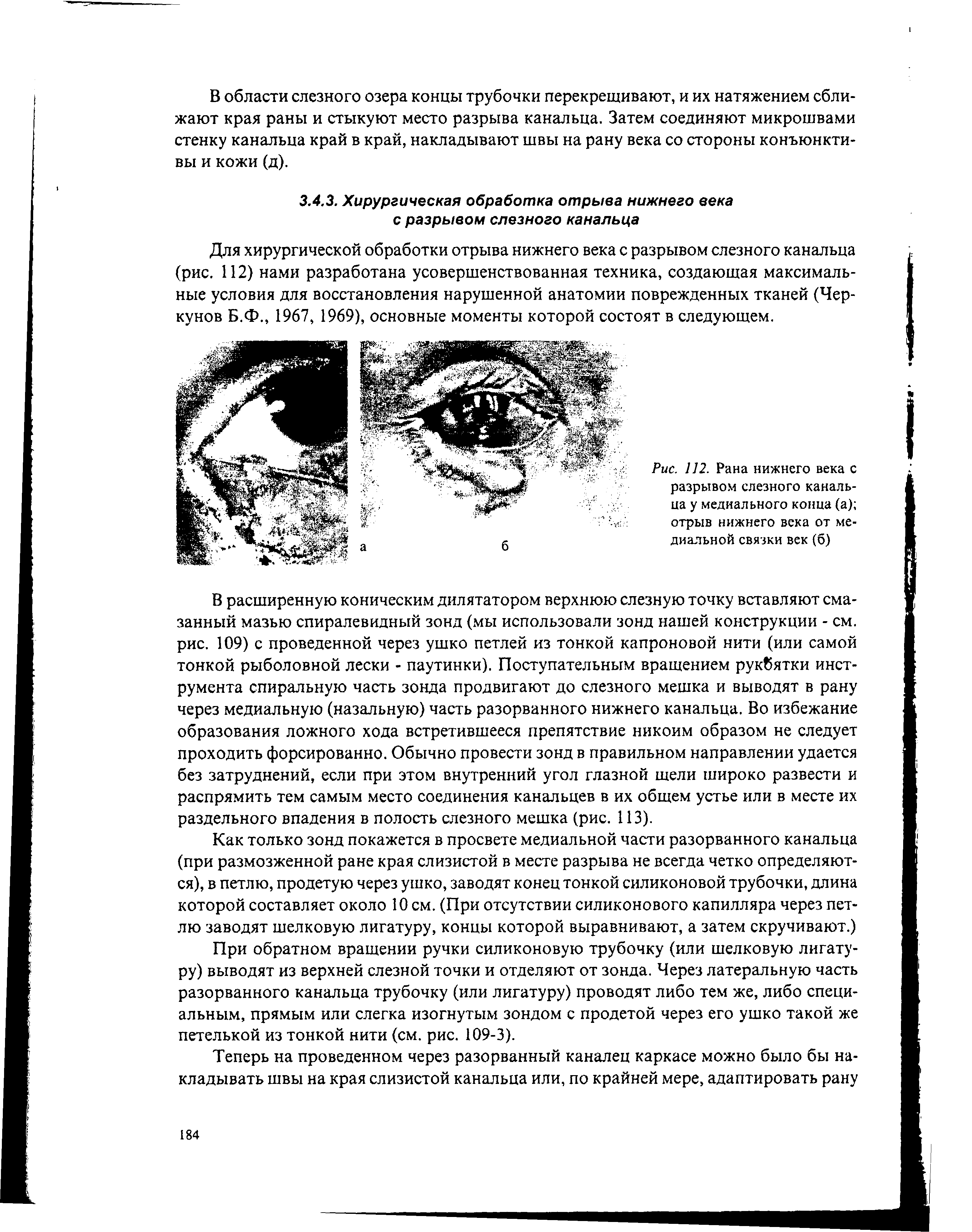 Рис. 112. Рана нижнего века с разрывом слезного канальца у медиального конца (а) отрыв нижнего века от медиальной связки век (б)...