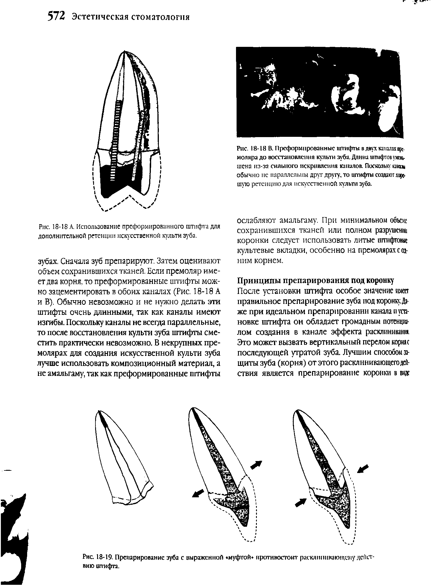 Рис. 18-18 А. Использование преформированного штифта для дополнительной ретенции искусственной культи зуба.