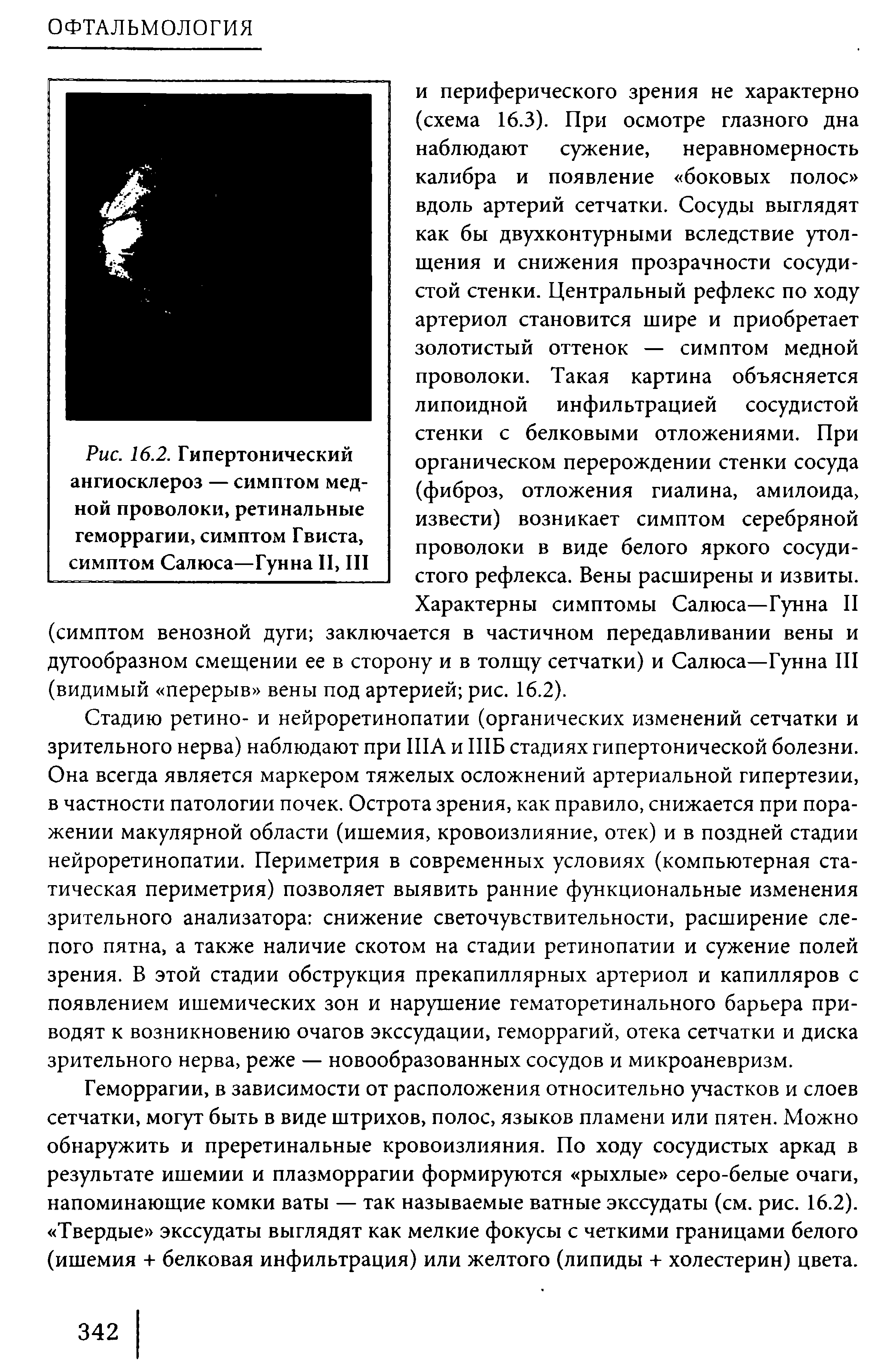 Рис. 16.2. Гипертонический ангиосклероз — симптом медной проволоки, ретинальные геморрагии, симптом Гвиста, симптом Салюса—Гунна II, III...