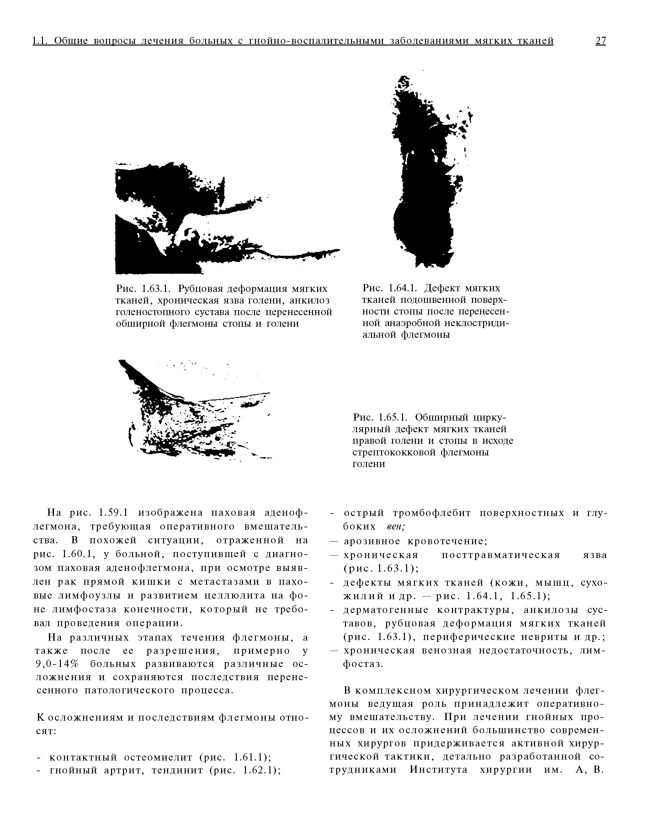 Рис. 1.63.1. Рубцовая деформация мягких тканей, хроническая язва голени, анкилоз голеностопного сустава после перенесенной обширной флегмоны стопы и голени...