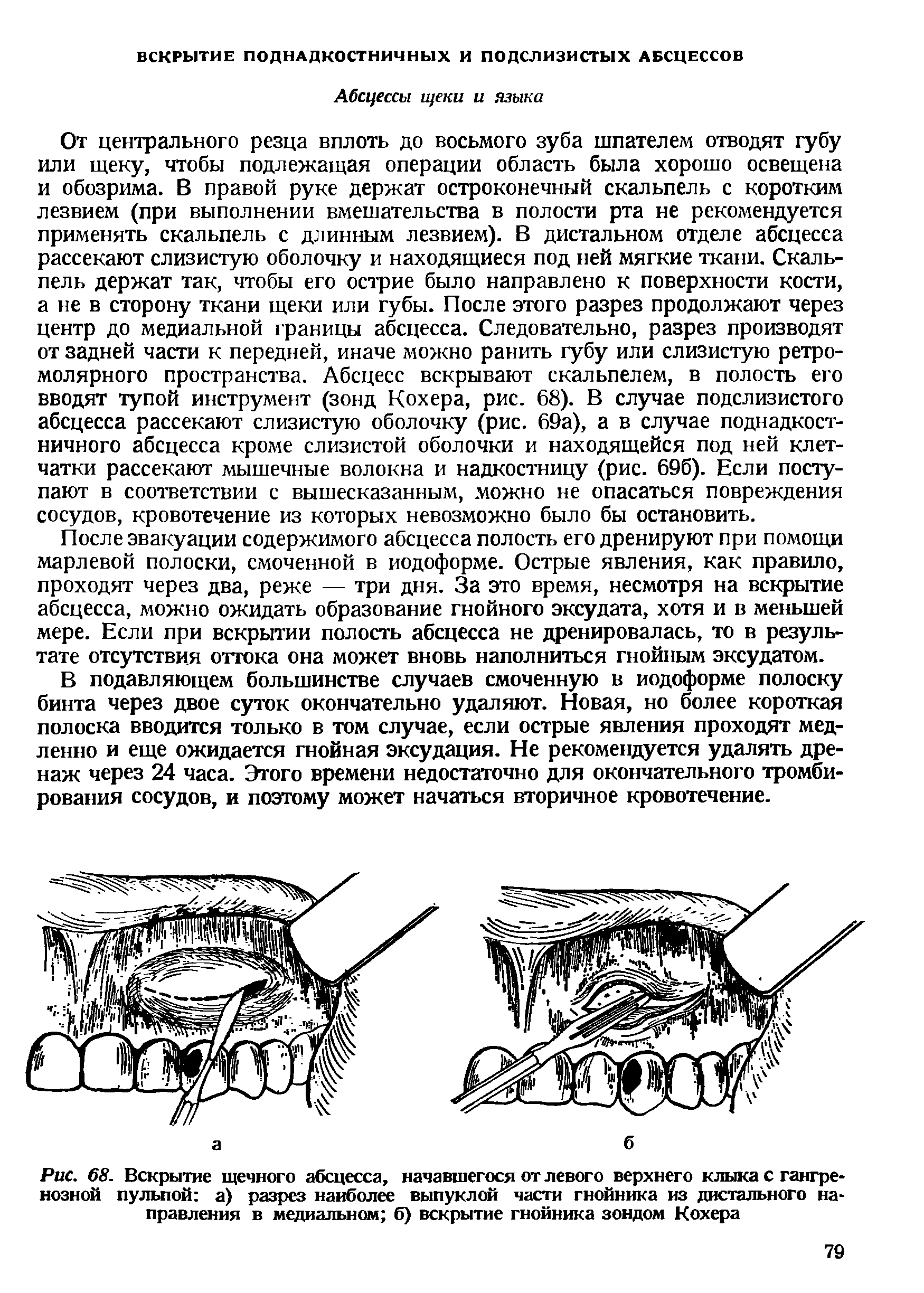 Рис. 68. Вскрытие щечного абсцесса, начавшегося от левого верхнего клыка с гангренозной пульпой а) разрез наиболее выпуклой части гнойника из дистального направления в медиальном б) вскрытие гнойника зондом Кохера...