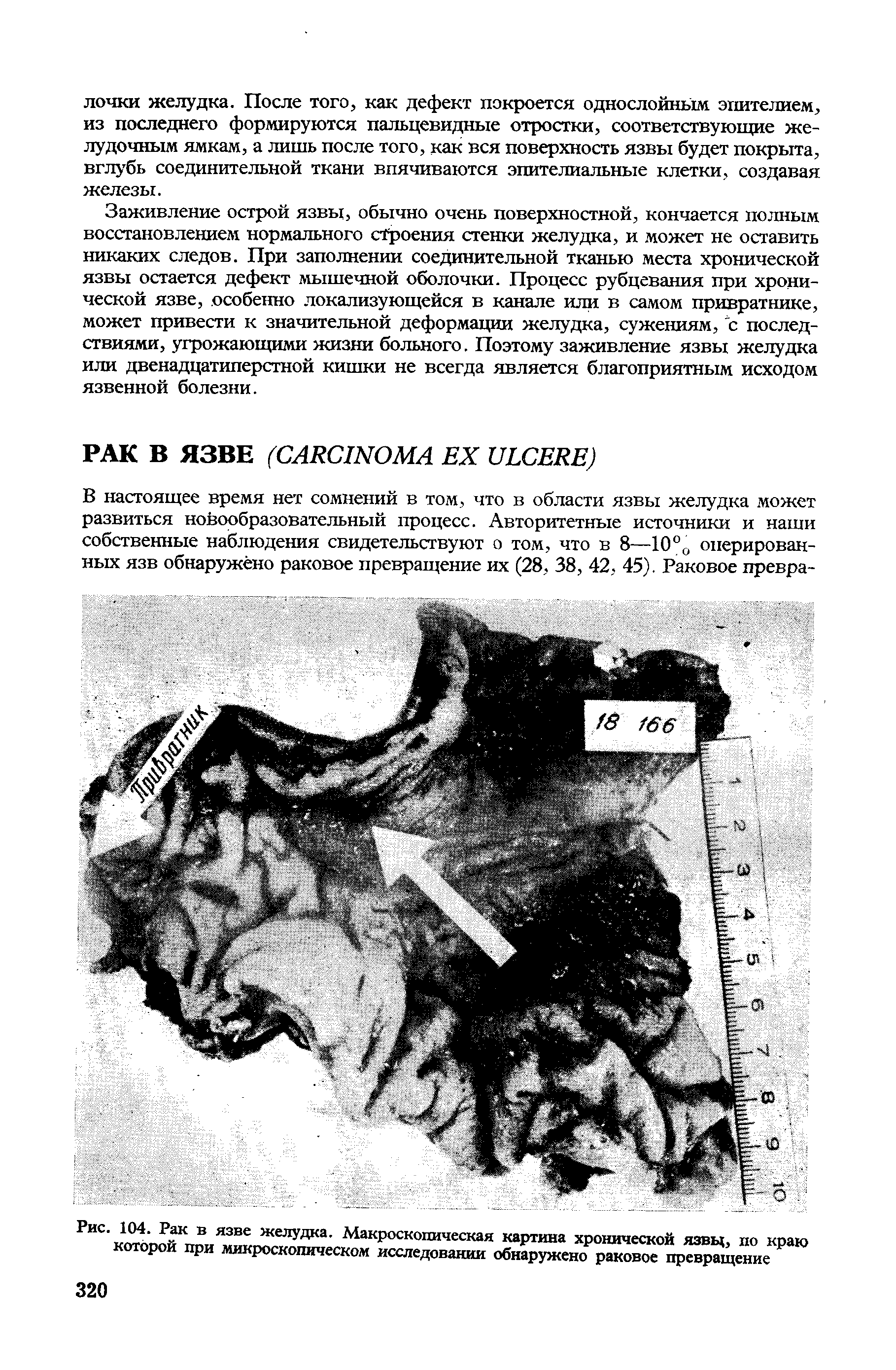 Рис. 104. Рак в язве желудка. Макроскопическая картина хронической язвы, по краю которой при микроскопическом исследовании обнаружено раковое превращение...