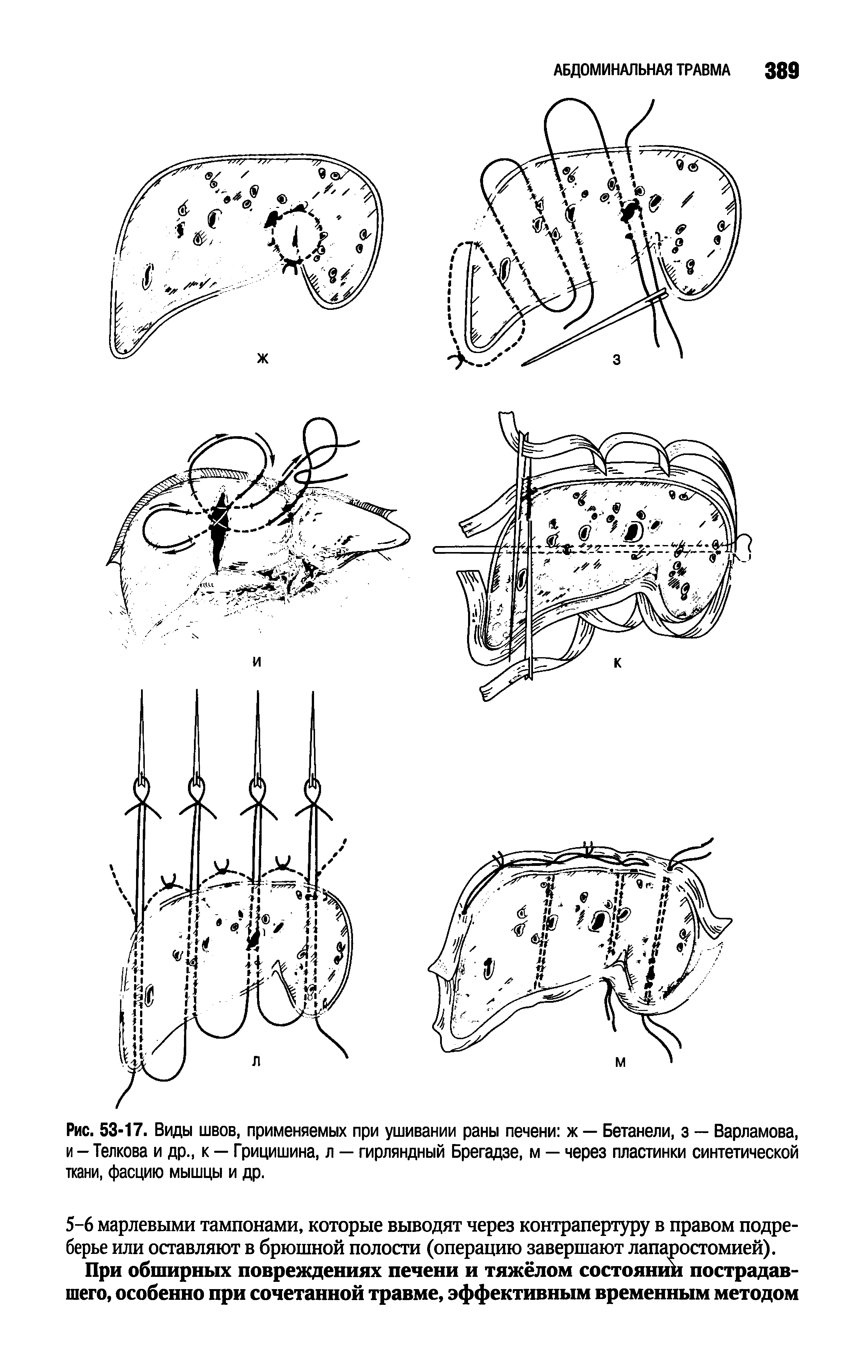 Рис. 53-17. Виды швов, применяемых при ушивании раны печени ж — Бетанели, з — Варламова, и - Телкова и др., к — Грицишина, л — гирляндный Брегадзе, м — через пластинки синтетической ткани, фасцию мышцы и др.