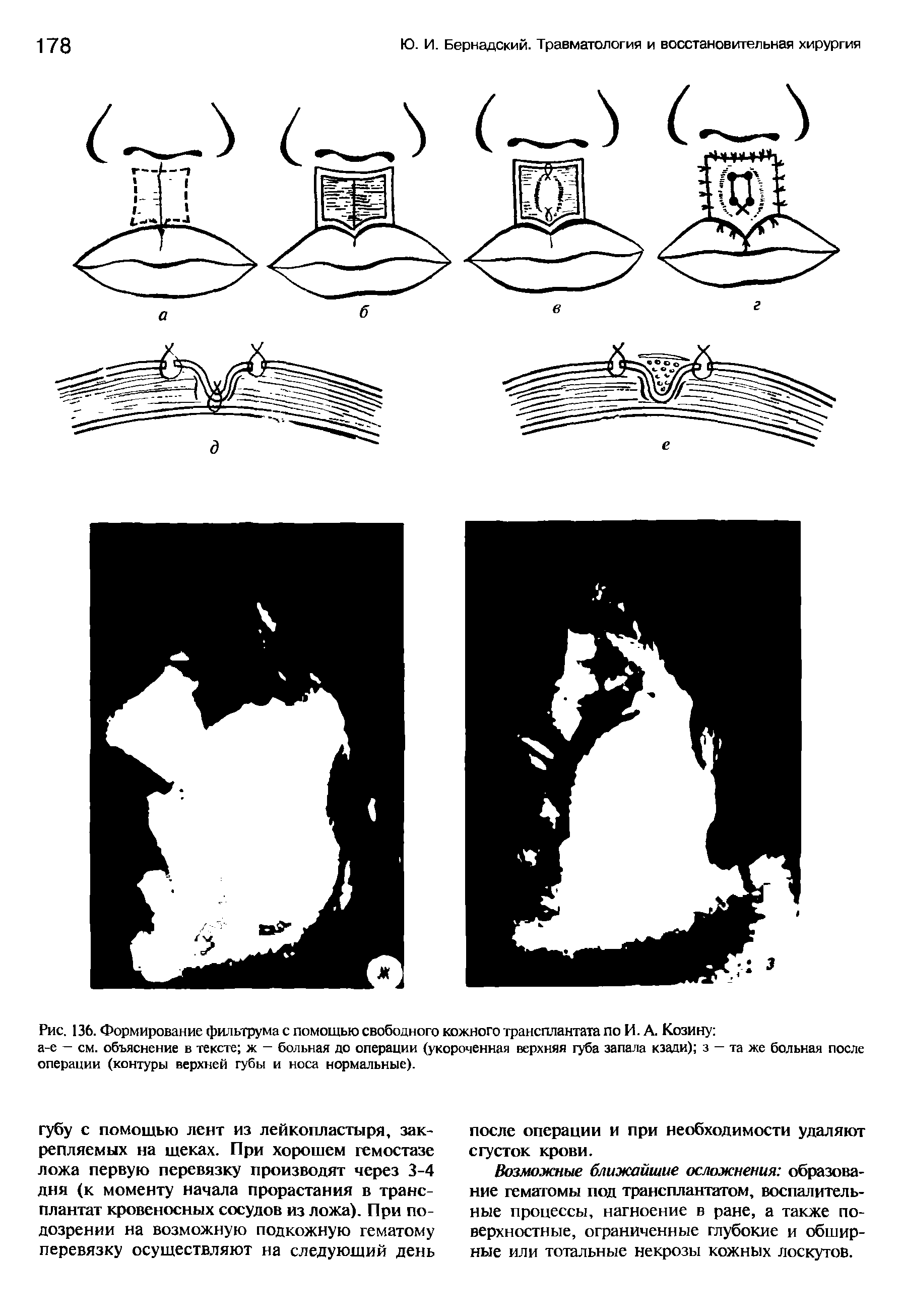 Рис. 136. Формирование фильтрума с помощью свободного кожного трансплантата по И. А. Козину ...