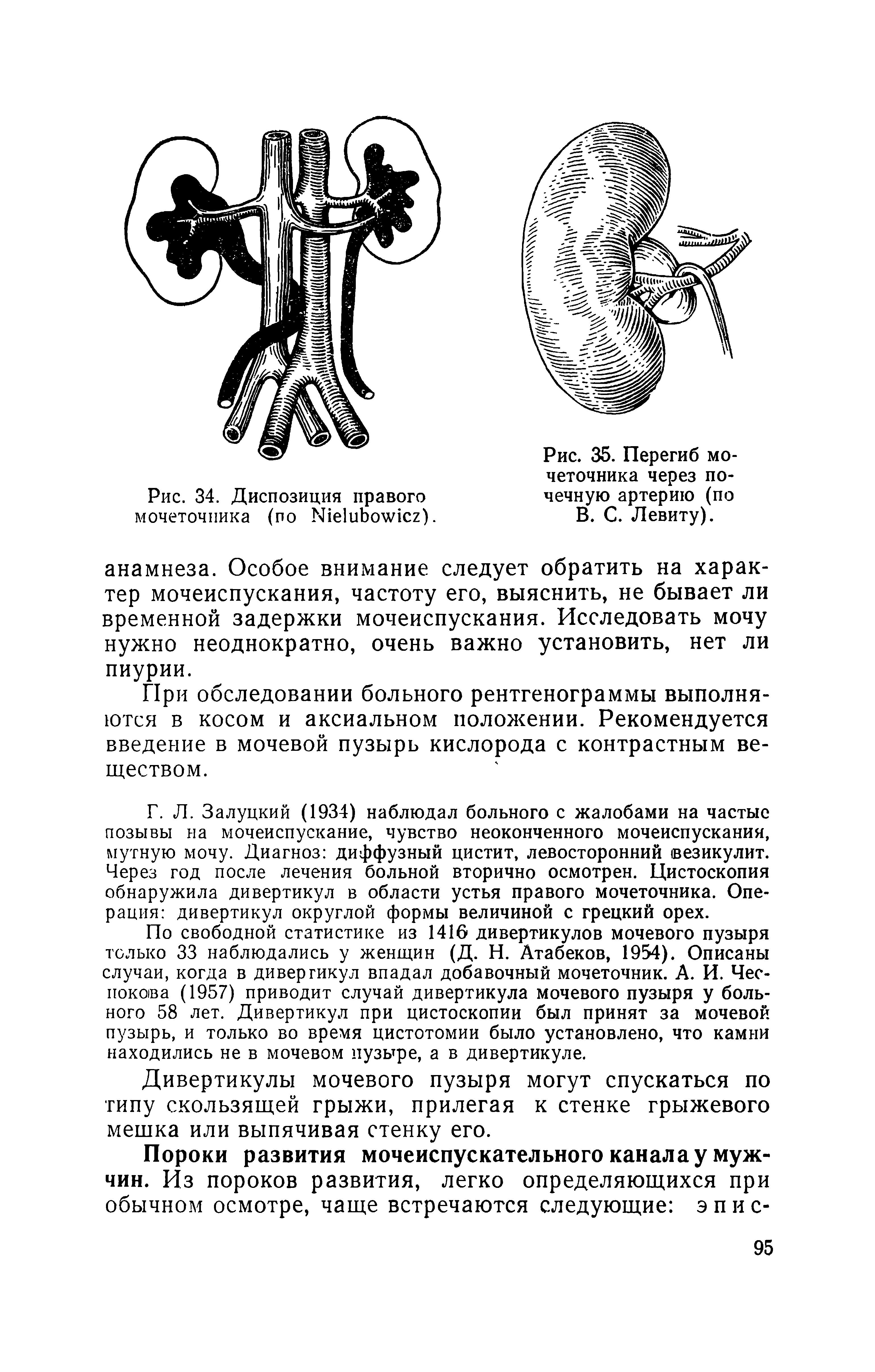 Рис. 35. Перегиб мочеточника через почечную артерию (по В. С. Левиту).