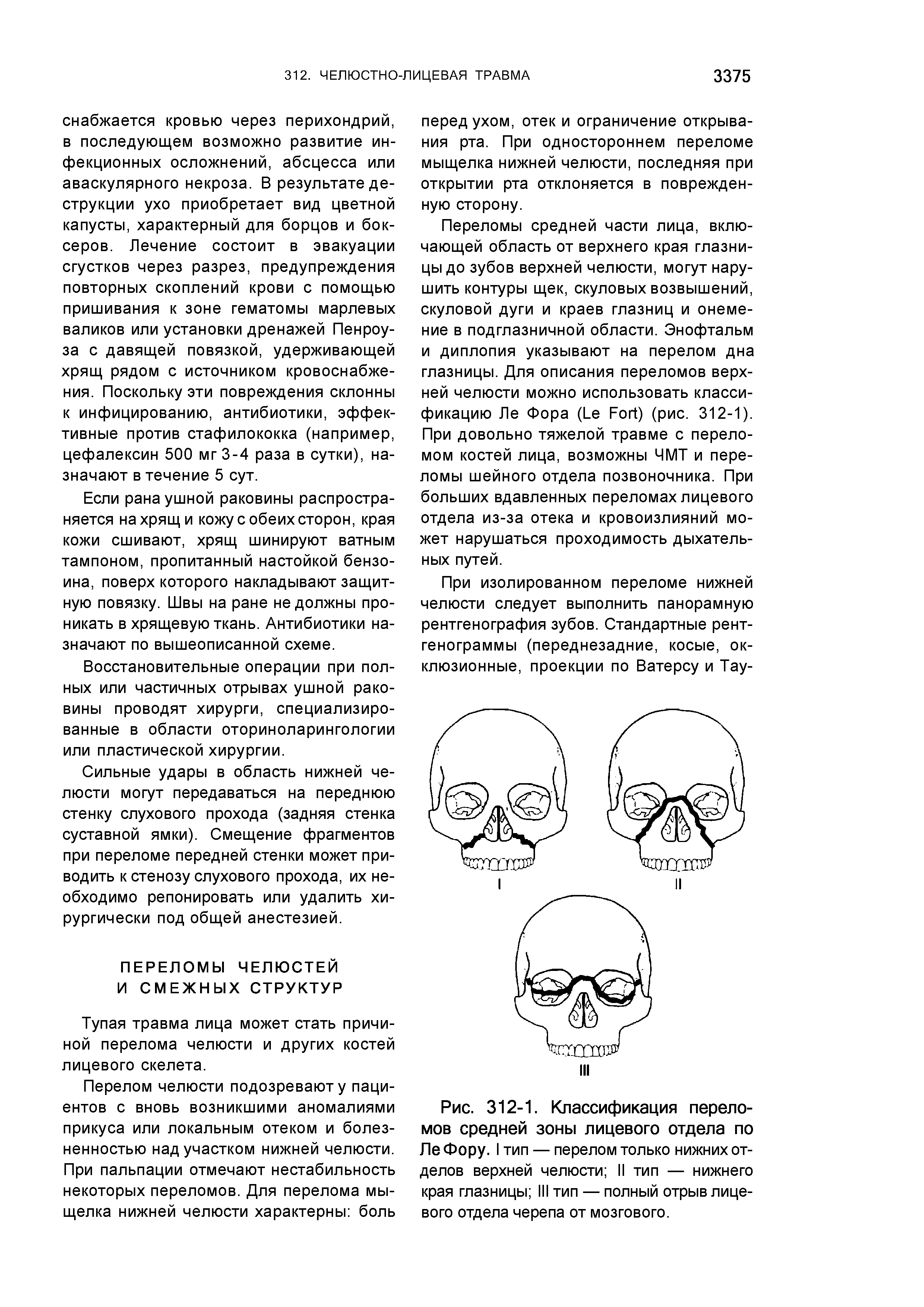 Рис. 312-1. Классификация переломов средней зоны лицевого отдела по ЛеФору. I тип — перелом только нижних отделов верхней челюсти II тип — нижнего края глазницы III тип — полный отрыв лицевого отдела черепа от мозгового.
