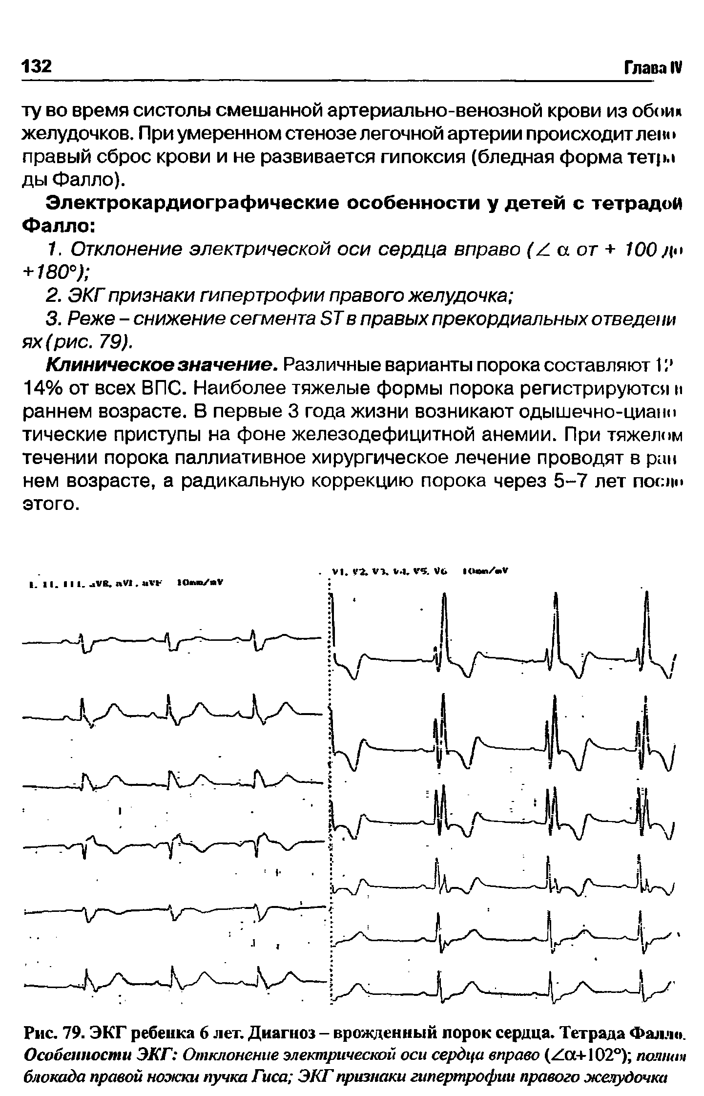 Рис. 79. ЭКГ ребенка 6 лет. Диагноз - врожденный порок сердца. Тетрада Фалло.