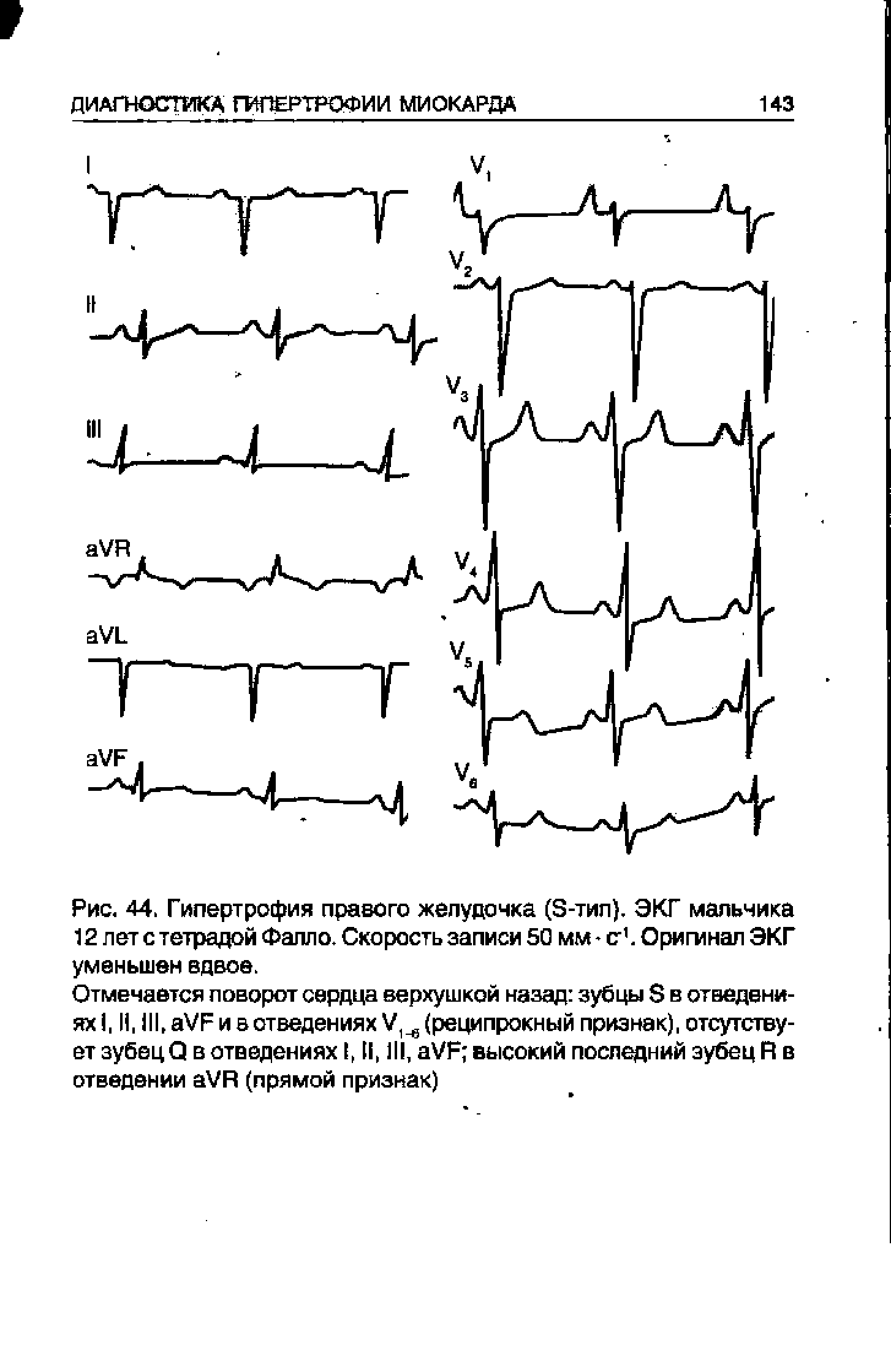 Рис. 44. Гипертрофия правого желудочка (S-тип). ЭКГ мальчика 12 лет с тетрадой Фалло. Скорость записи 50 мм - с . Оригинал ЭКГ уменьшен вдвое.