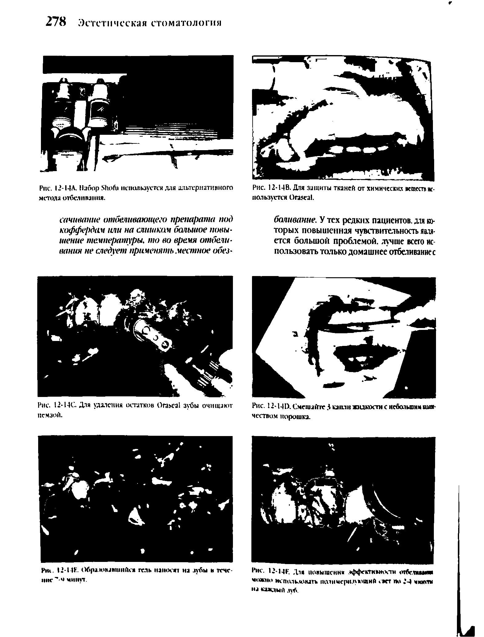 Рис. 12-14А. Набор 51юб1 используется для альтернативного метода отбеливания.