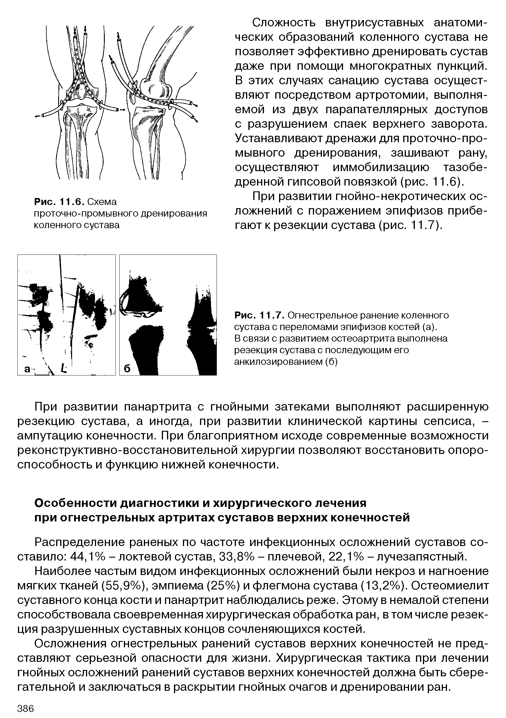 Рис. 11.7. Огнестрельное ранение коленного сустава с переломами эпифизов костей (а).