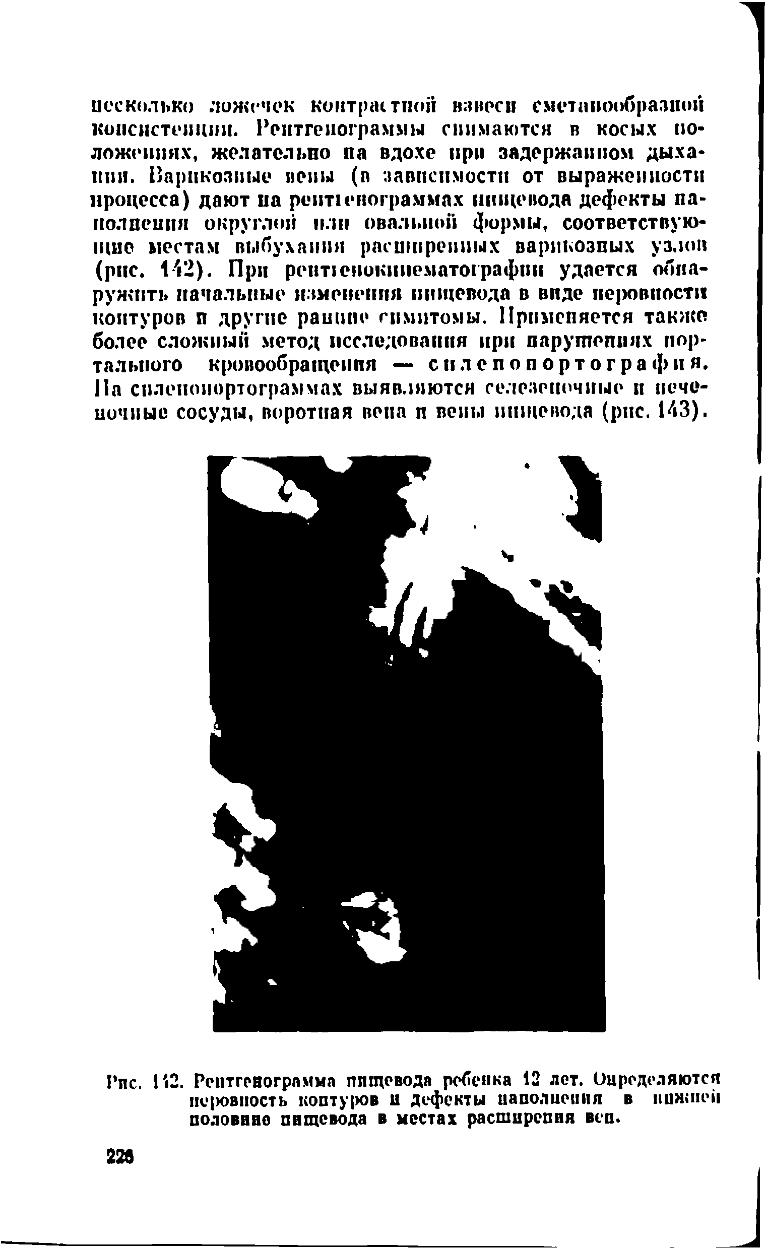 Рис. 142. Рентгенограмма пищевода ребенка 12 лет. Оцределяются пе ювпость коптуров и дефекты наполнения в нижней половине пищевода в местах расширеппя веп.