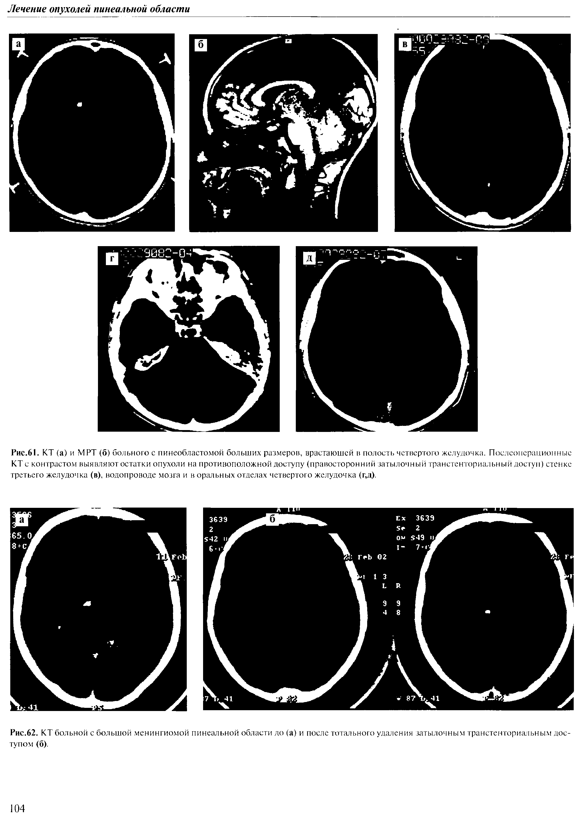 Рис.61. КТ (а) и МРТ (6) больного с пинеобластомой больших размеров, врастающей в полость четвертого желудочка. Послеоперационные КТ с контрастом выявляют остатки опухоли на противоположной доступу (правосторонний затылочный транстенториальный доступ) стенке третьего желудочка (в), водопроводе мозга и в ор шьных отделах четвертого желудочка (г,д).