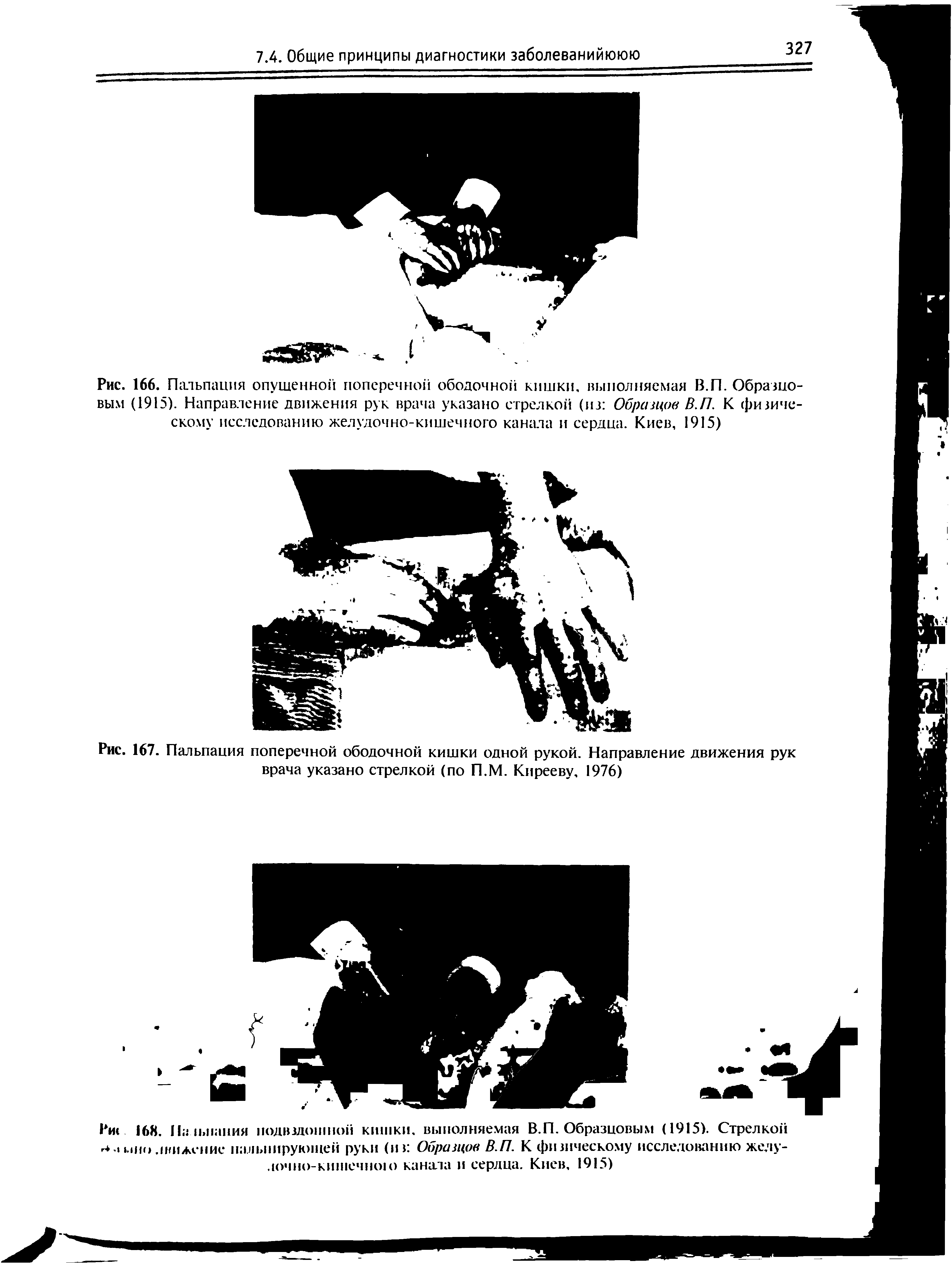 Рис. 166. Пальпация опущенной поперечной ободочной кишки, выполняемая В.П. Образно вым (1915). Направление движения рук врача указано стрелкой (из Образцов В.П. К физиче скому исследованию желудочно-кишечного канала и сердца. Киев, 1915)...