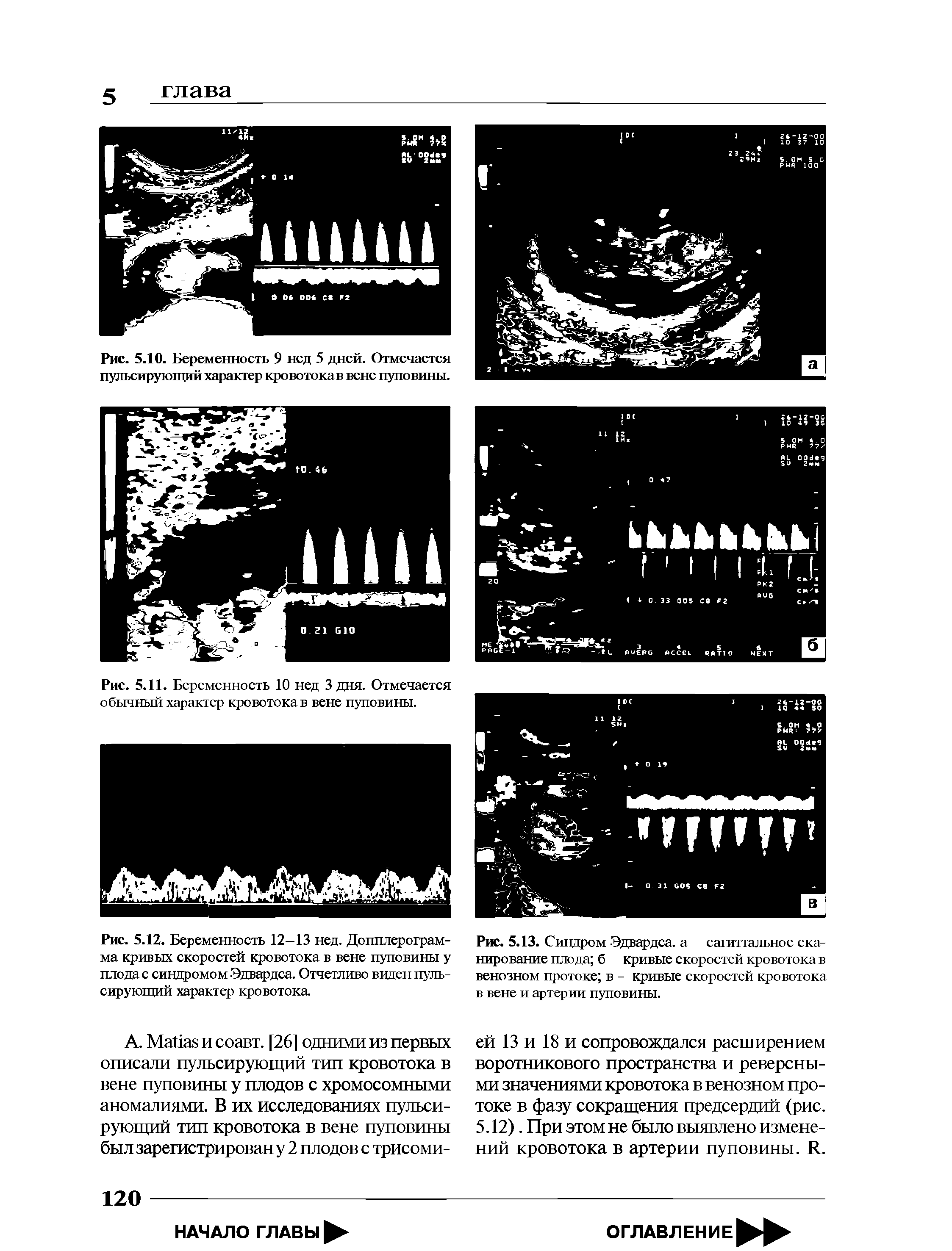 Рис. 5.13. Синдром Эдвардса, а сагиттальное сканирование плода б кривые скоростей кровотока в венозном протоке в - кривые скоростей кровотока в вене и артерии пуповины.