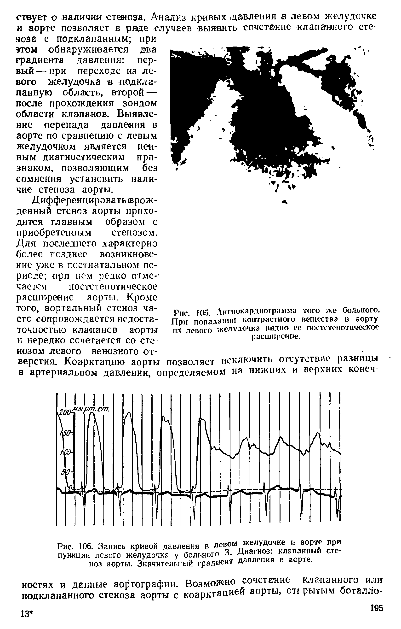 Рис. 106. Запись кривой давления в лев°МЛагног клапашшй сте-пункции левого желудочка у больного 3. Диагноз, к...