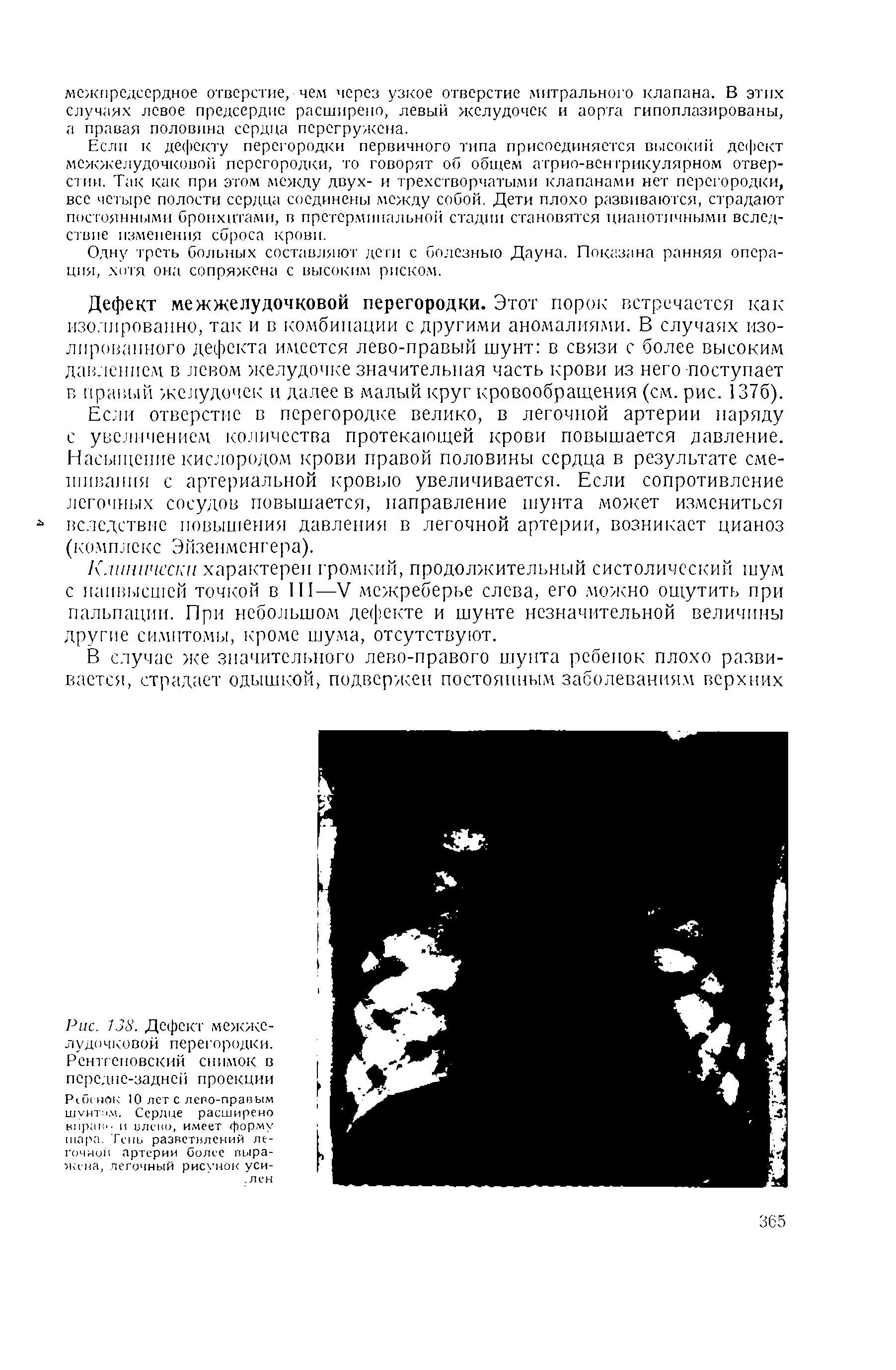 Рис. 138. Дефект межжелудочковой перегородки. Рентгеновский снимок в передне-задней проекции Р<Си-нок 10 лет с лево-правым шунтом, Сердце расширено вирагн- и влево, имеет форму шара. Тень разветвлений легочной артерии более выражена, легочный рисунок уси-. лен...