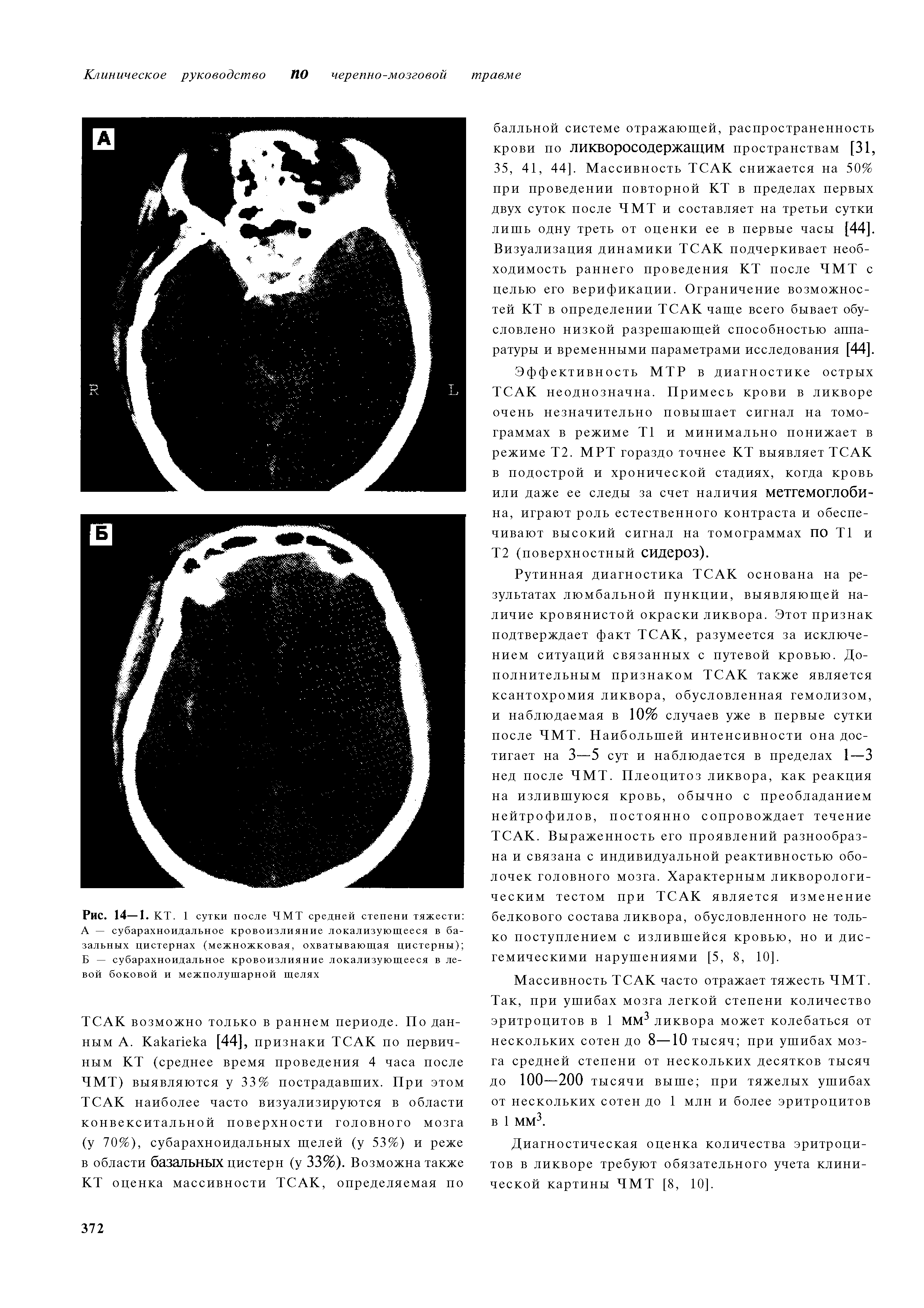 Рис. 14-1. КТ. 1 сутки после ЧМТ средней степени тяжести А — субарахноидальное кровоизлияние локализующееся в базальных цистернах (межножковая, охватывающая цистерны) Б — субарахноидальное кровоизлияние локализующееся в левой боковой и межполушарной щелях...