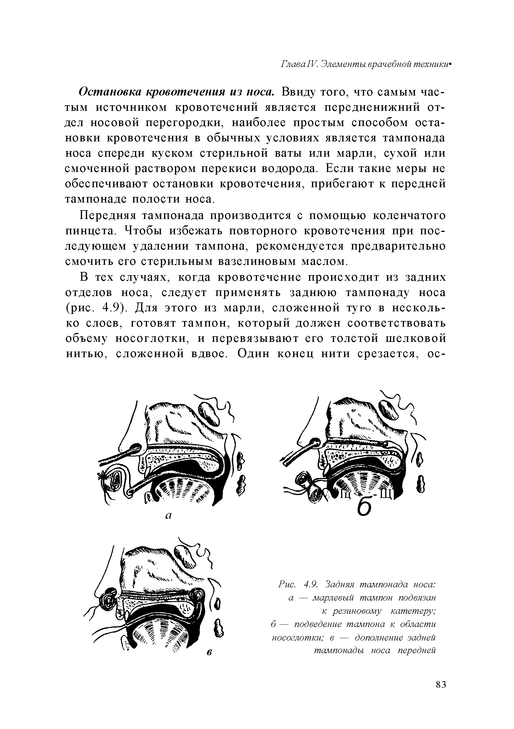 Рис. 4.9. Задняя тампонада носа а — марлевый тампон подвязан к резиновому катетеру б — подведение тампона к области носоглотки в — дополнение задней тампонады носа передней...