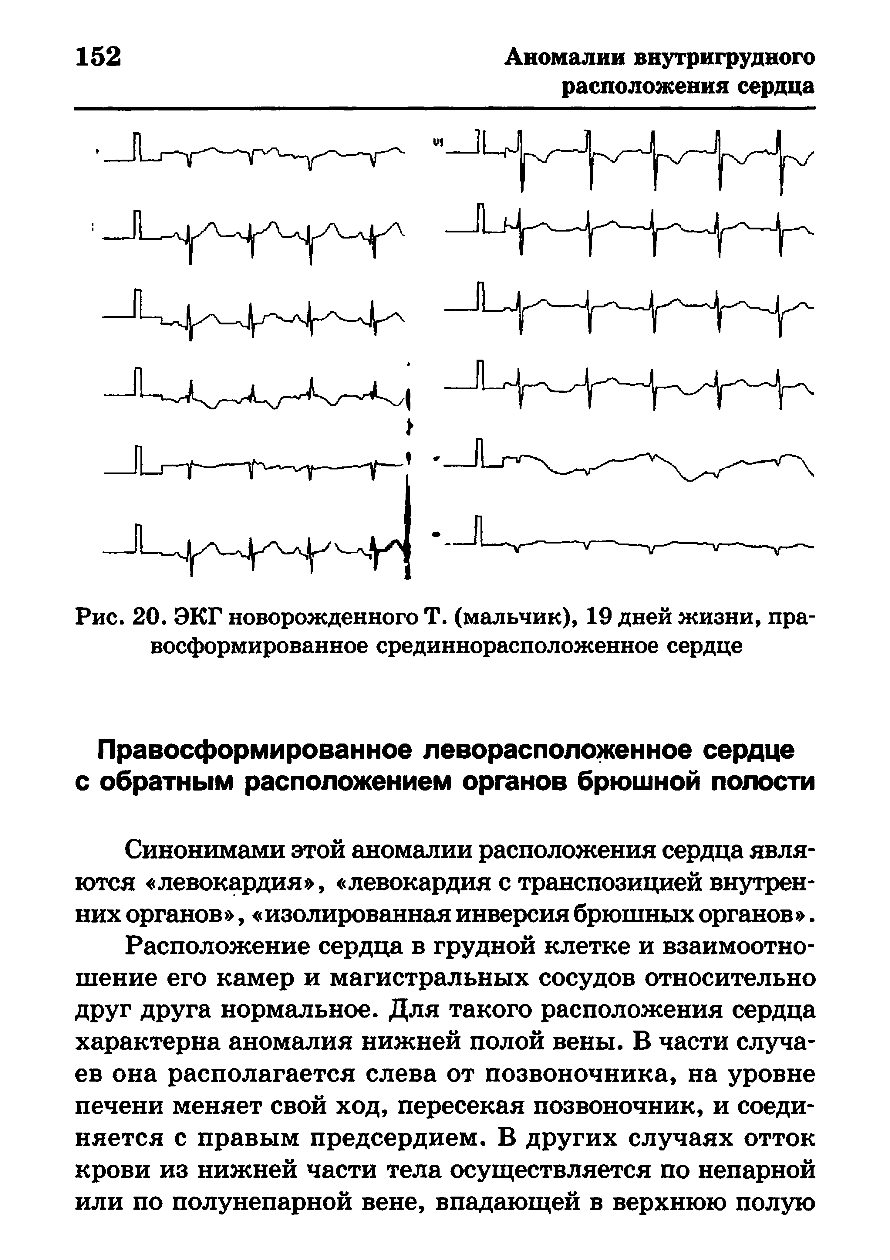 Рис. 20. ЭКГ новорожденного Т. (мальчик), 19 дней жизни, правосформированное срединнорасположенное сердце...