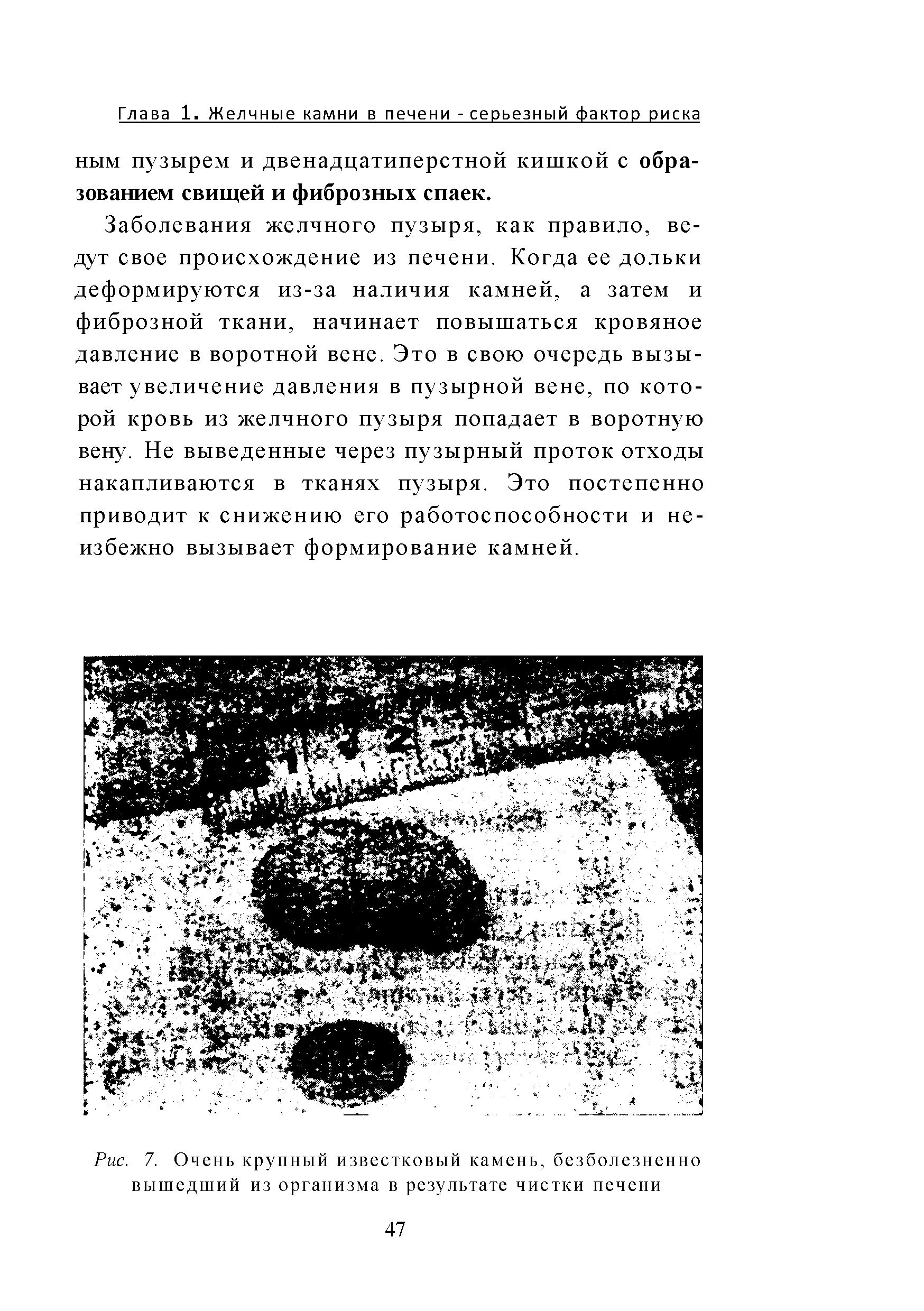 Рис. 7. Очень крупный известковый камень, безболезненно вышедший из организма в результате чистки печени...