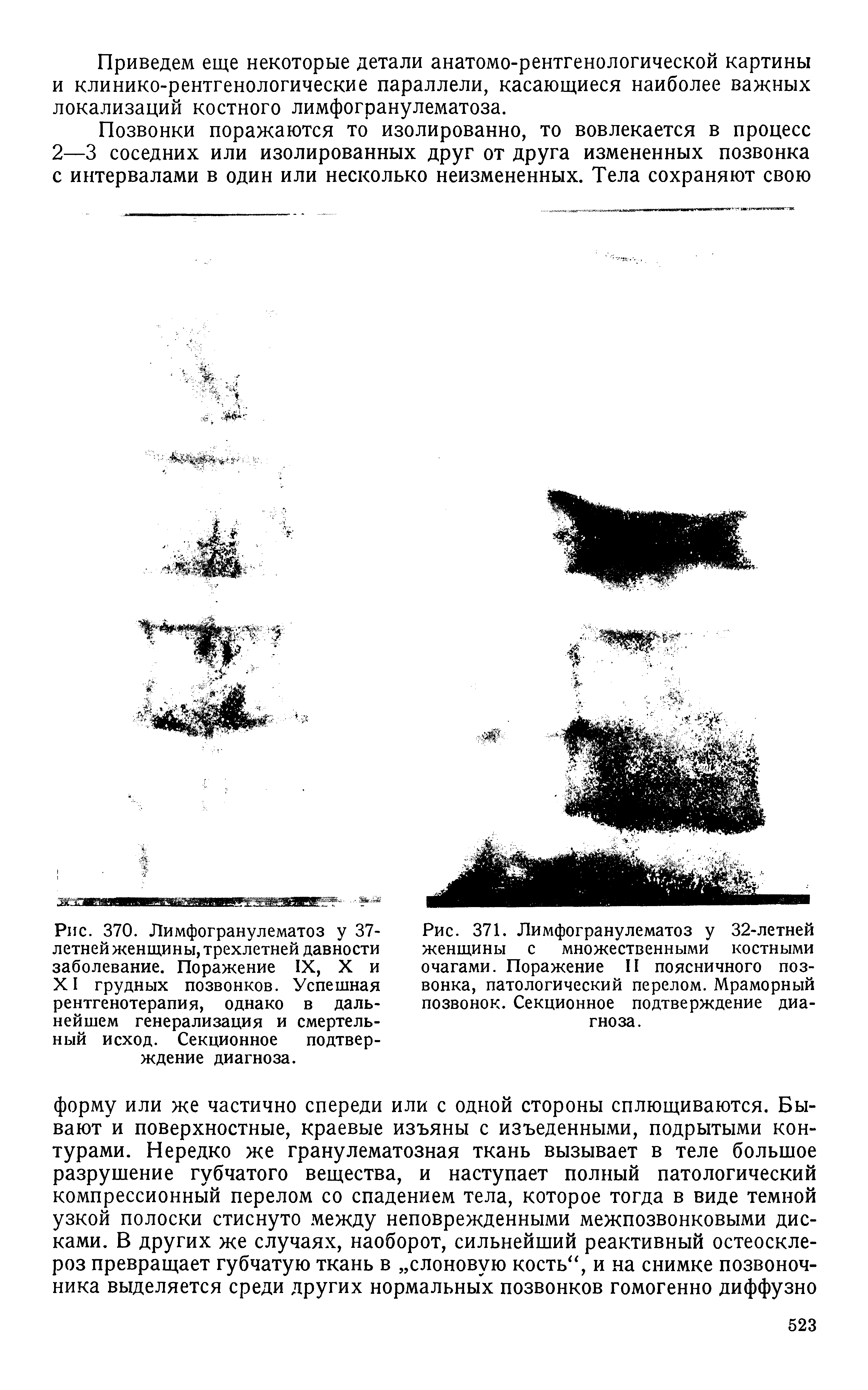 Рис. 371. Лимфогранулематоз у 32-летней женщины с множественными костными очагами. Поражение II поясничного позвонка, патологический перелом. Мраморный позвонок. Секционное подтверждение диагноза.