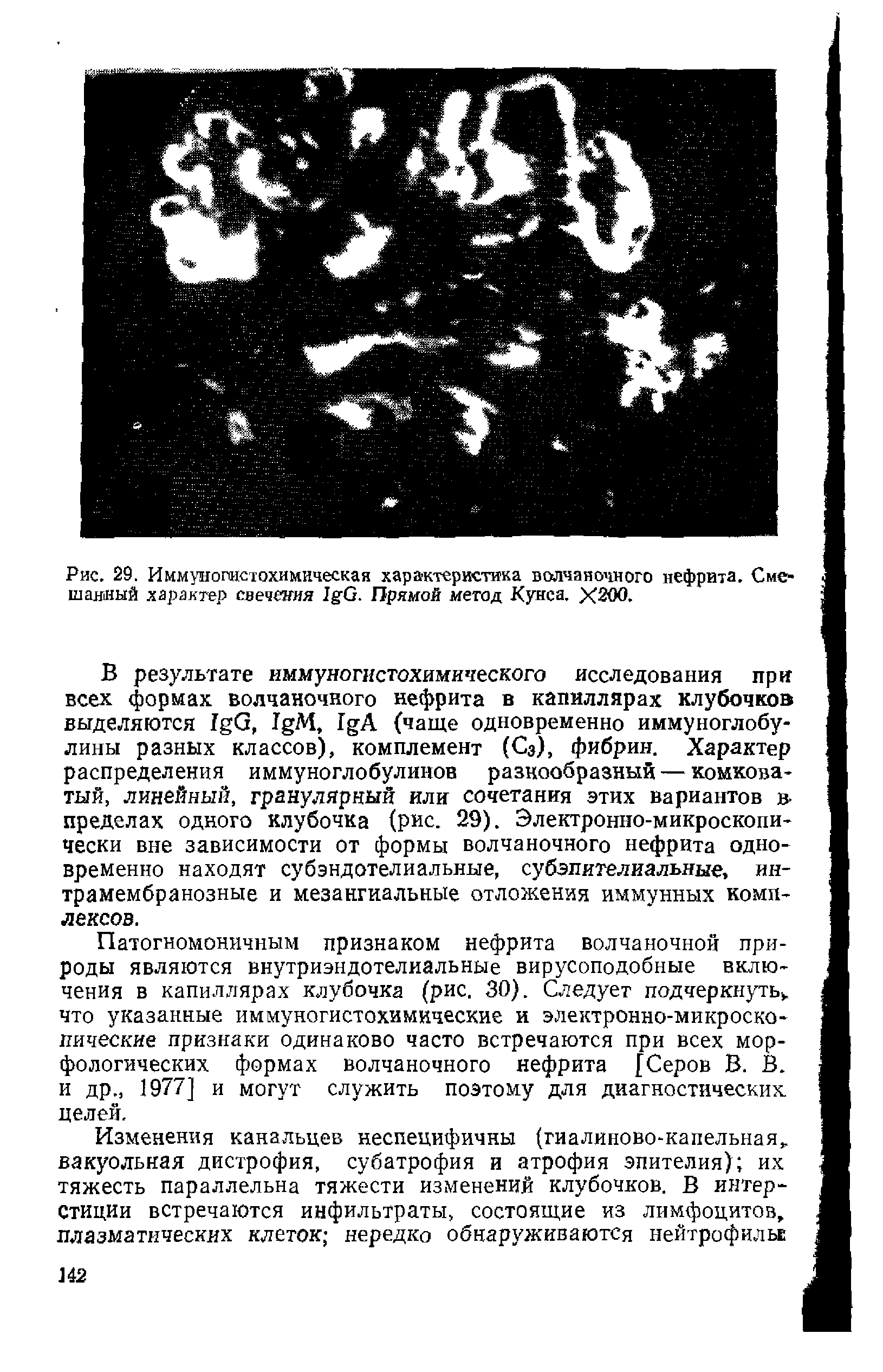 Рис. 29. Иммуногистохимическая характеристика волчаночного нефрита. Смешанный характер свечения I G. Прямой метод Кунса. Х200.