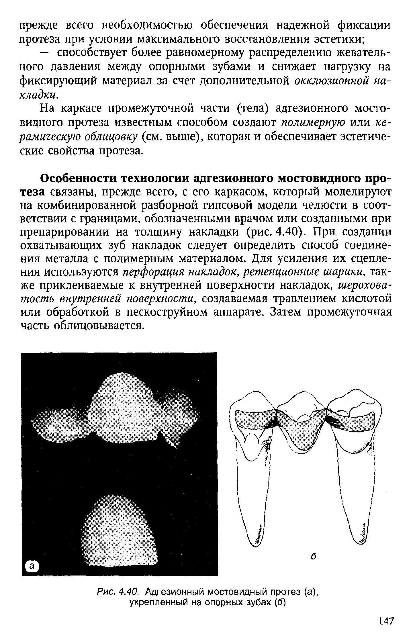 Рис. 4.40. Адгезионный мостовидный протез (а), укрепленный на опорных зубах (б)...