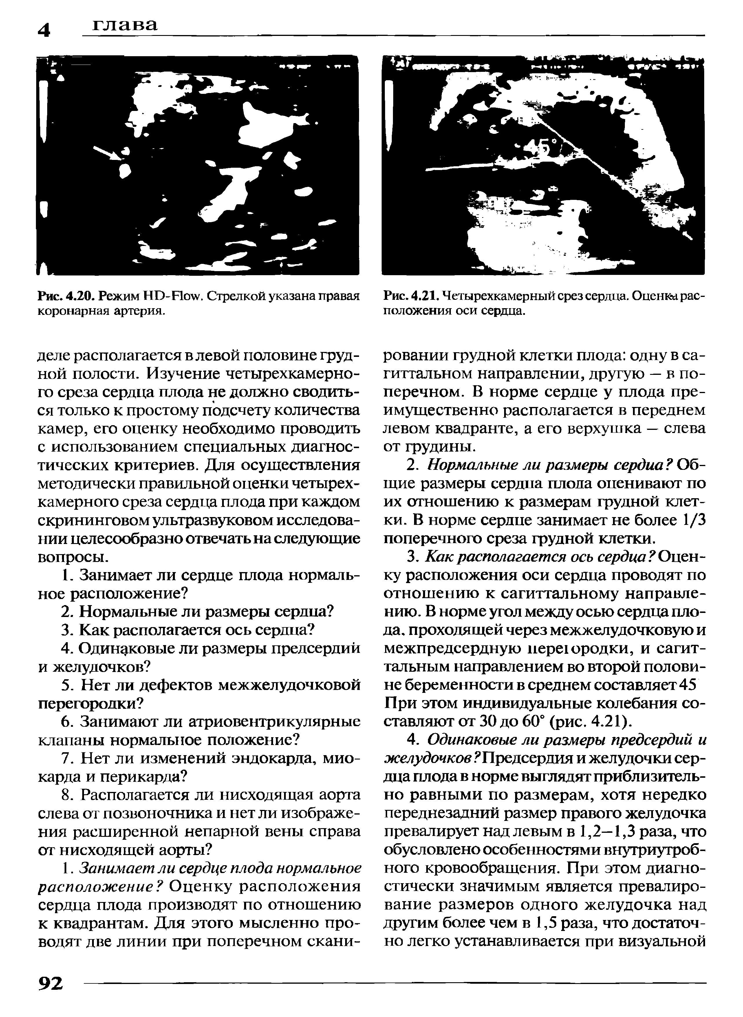 Рис. 4.21. Четырехкамерный срез сердца. Оценка расположения оси сердца.