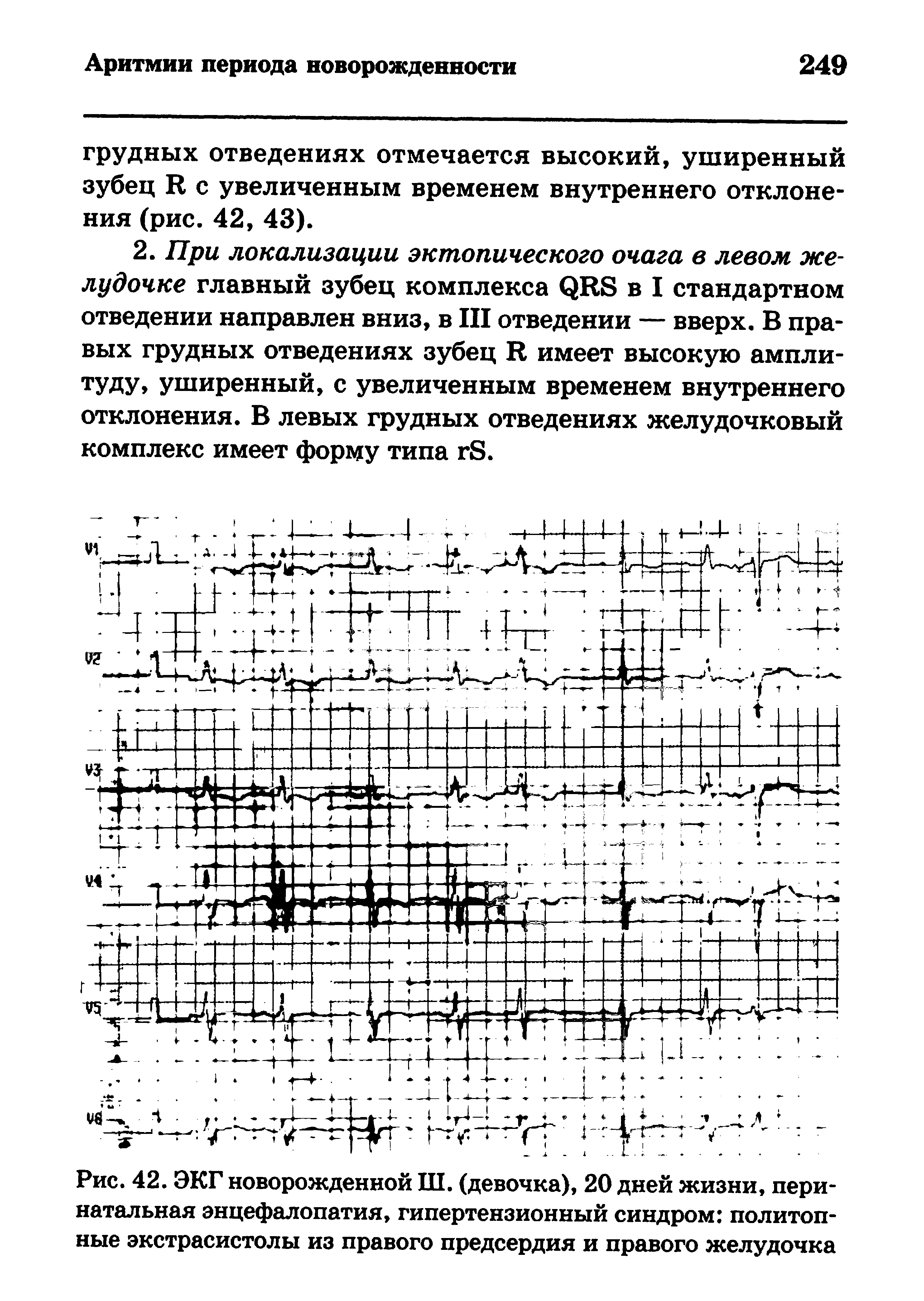 Рис. 42. ЭКГ новорожденной Ш. (девочка), 20 дней жизни, перинатальная энцефалопатия, гипертензионный синдром политоп-ные экстрасистолы из правого предсердия и правого желудочка...