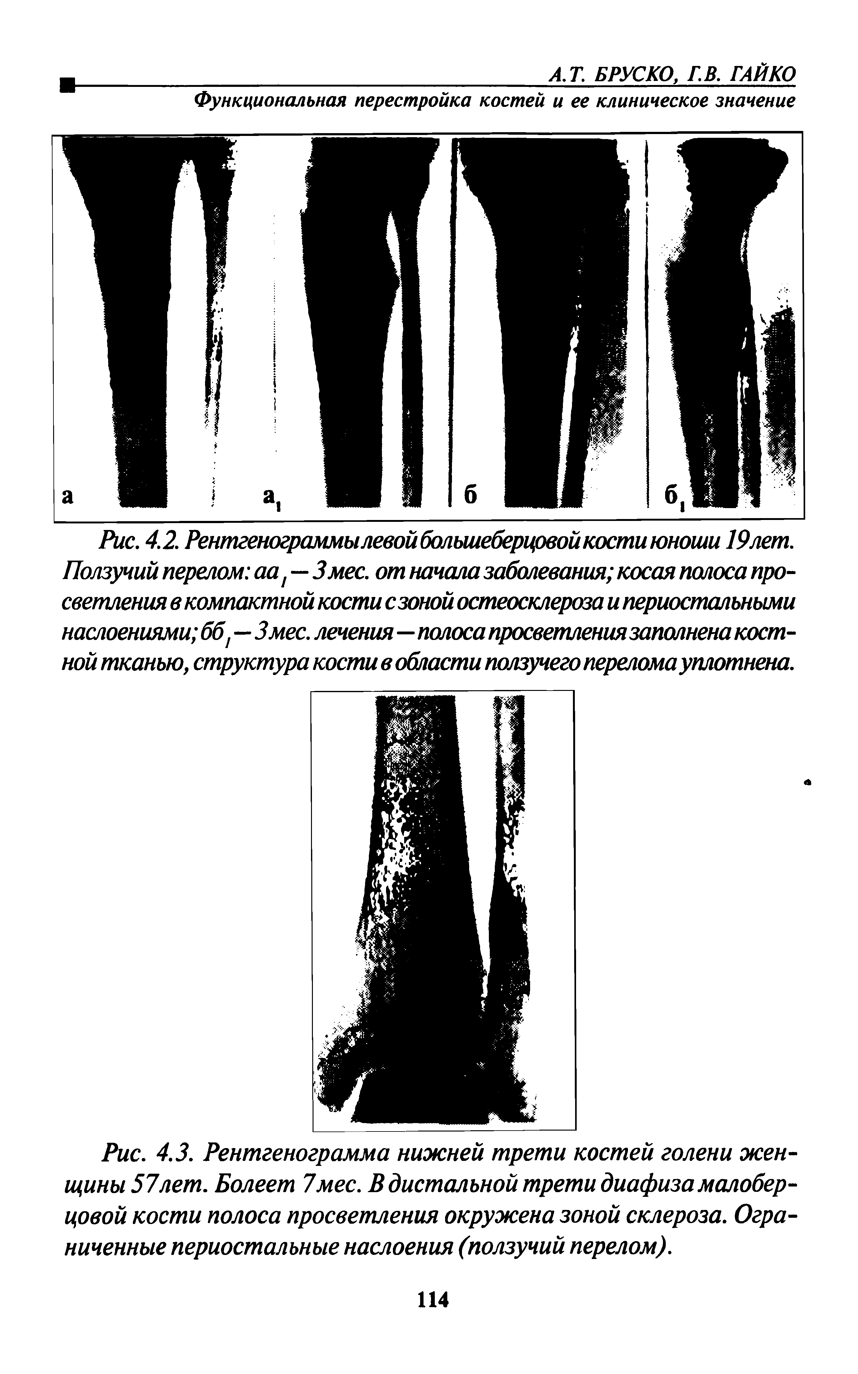 Рис. 4.3. Рентгенограмма нижней трети костей голени женщины 57 лет. Болеет 7мес. В дистальной трети диафиза малоберцовой кости полоса просветления окружена зоной склероза. Ограниченные периостальные наслоения (ползучий перелом).