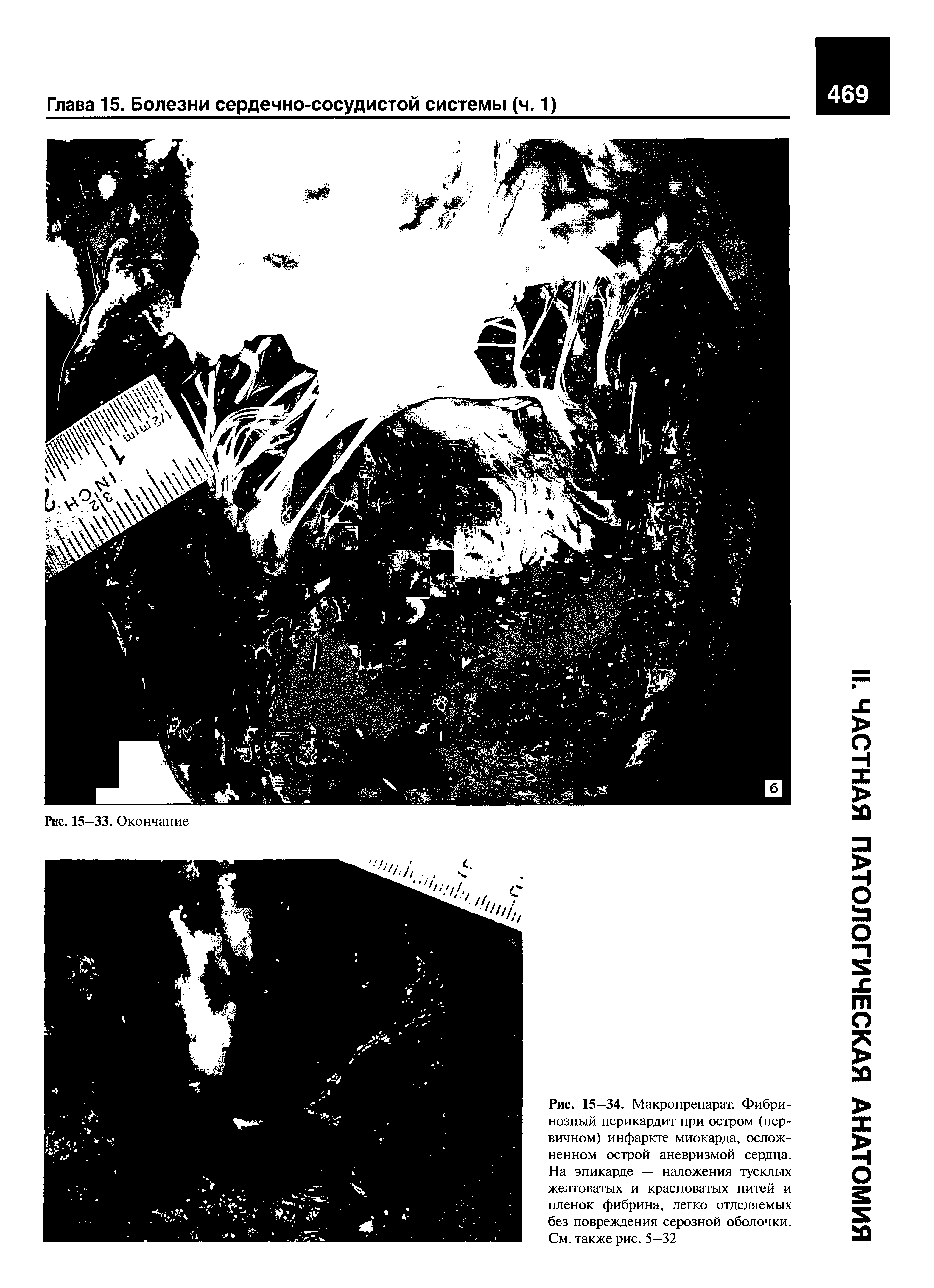 Рис. 15—34. Макропрепарат. Фибринозный перикардит при остром (первичном) инфаркте миокарда, осложненном острой аневризмой сердца. На эпикарде — наложения тусклых желтоватых и красноватых нитей и пленок фибрина, легко отделяемых без повреждения серозной оболочки. См. также рис. 5—32...