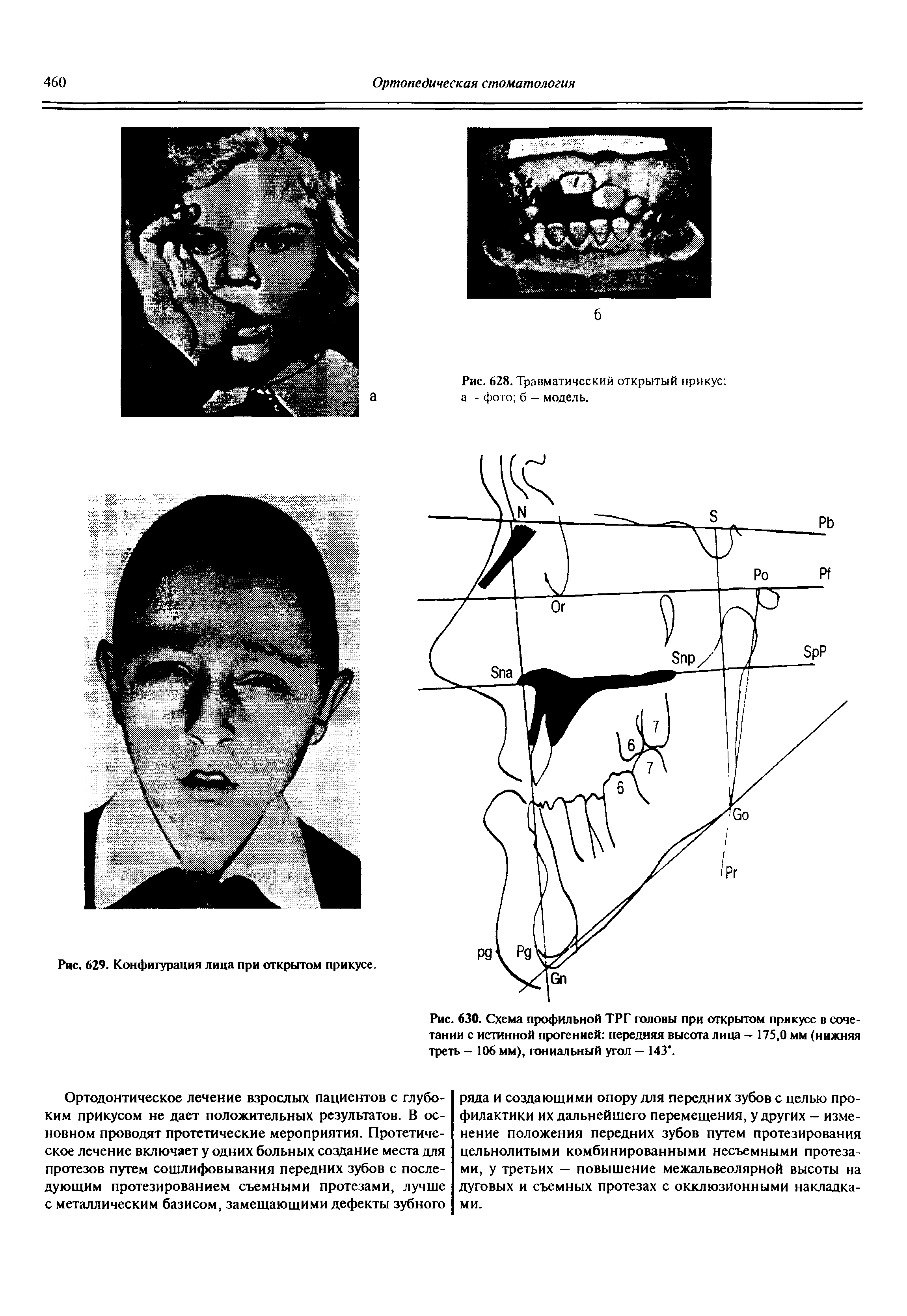 Рис. 630. Схема профильной ТРГ головы при открытом прикусе в сочетании с истинной прогенией передняя высота лица - 175,0 мм (нижняя треть - 106 мм), гениальный угол — 143".