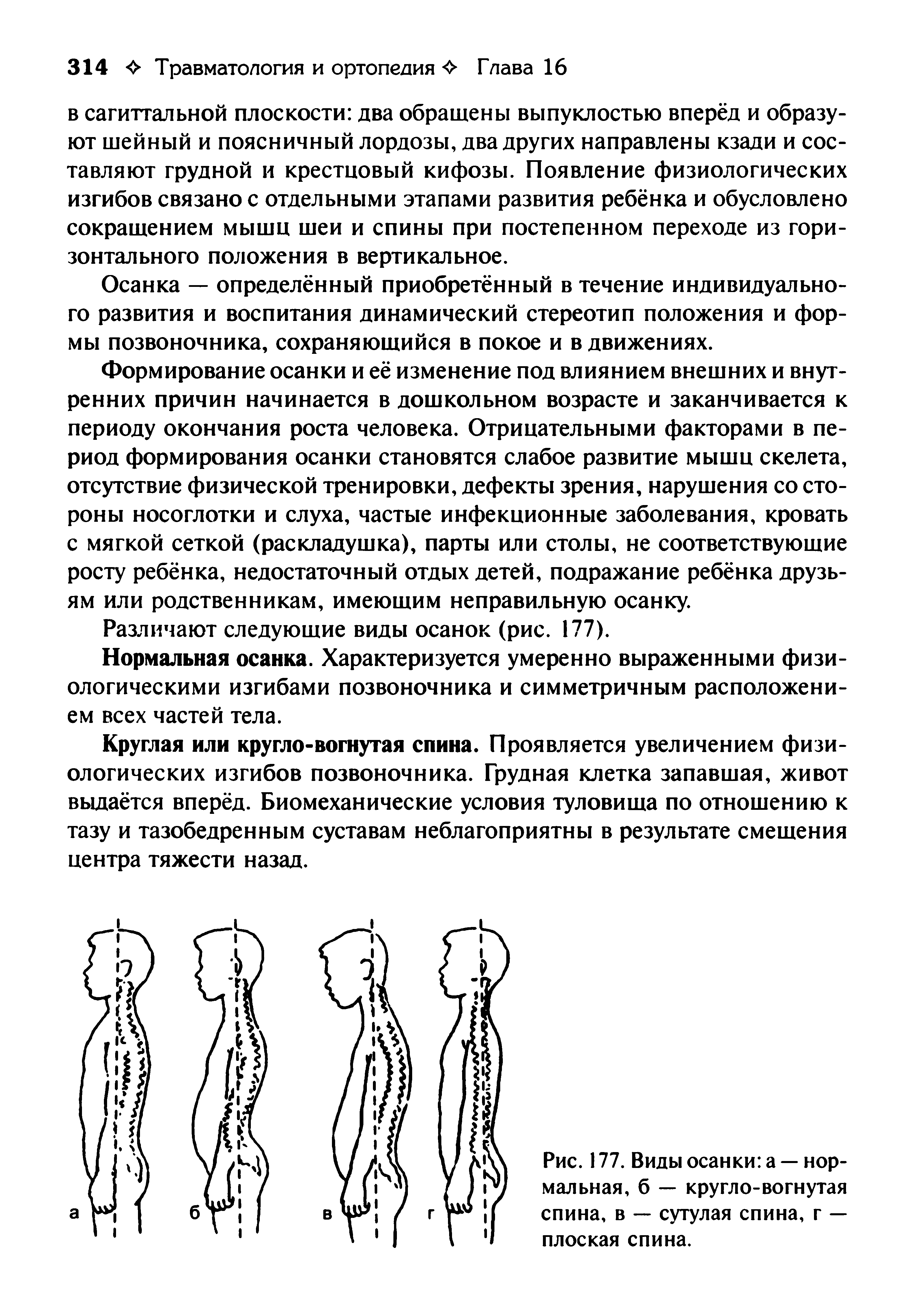 Рис. 177. Виды осанки а — нормальная, б — кругло-вогнутая спина, в — сутулая спина, г — плоская спина.