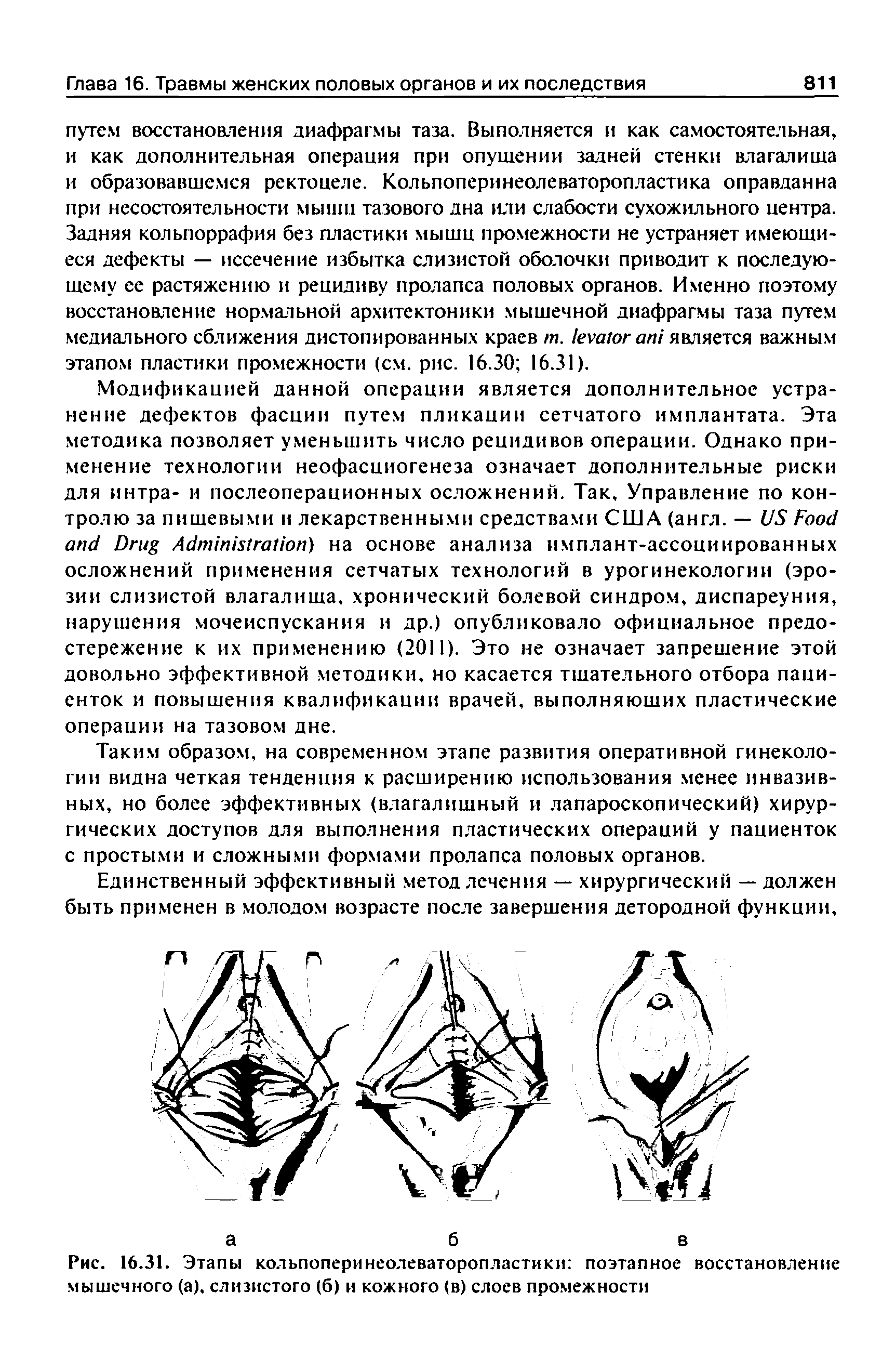 Рис. 16.31. Этапы кольпоперинеолеваторопластики поэтапное восстановление мышечного (а), слизистого (б) и кожного (в) слоев промежности...