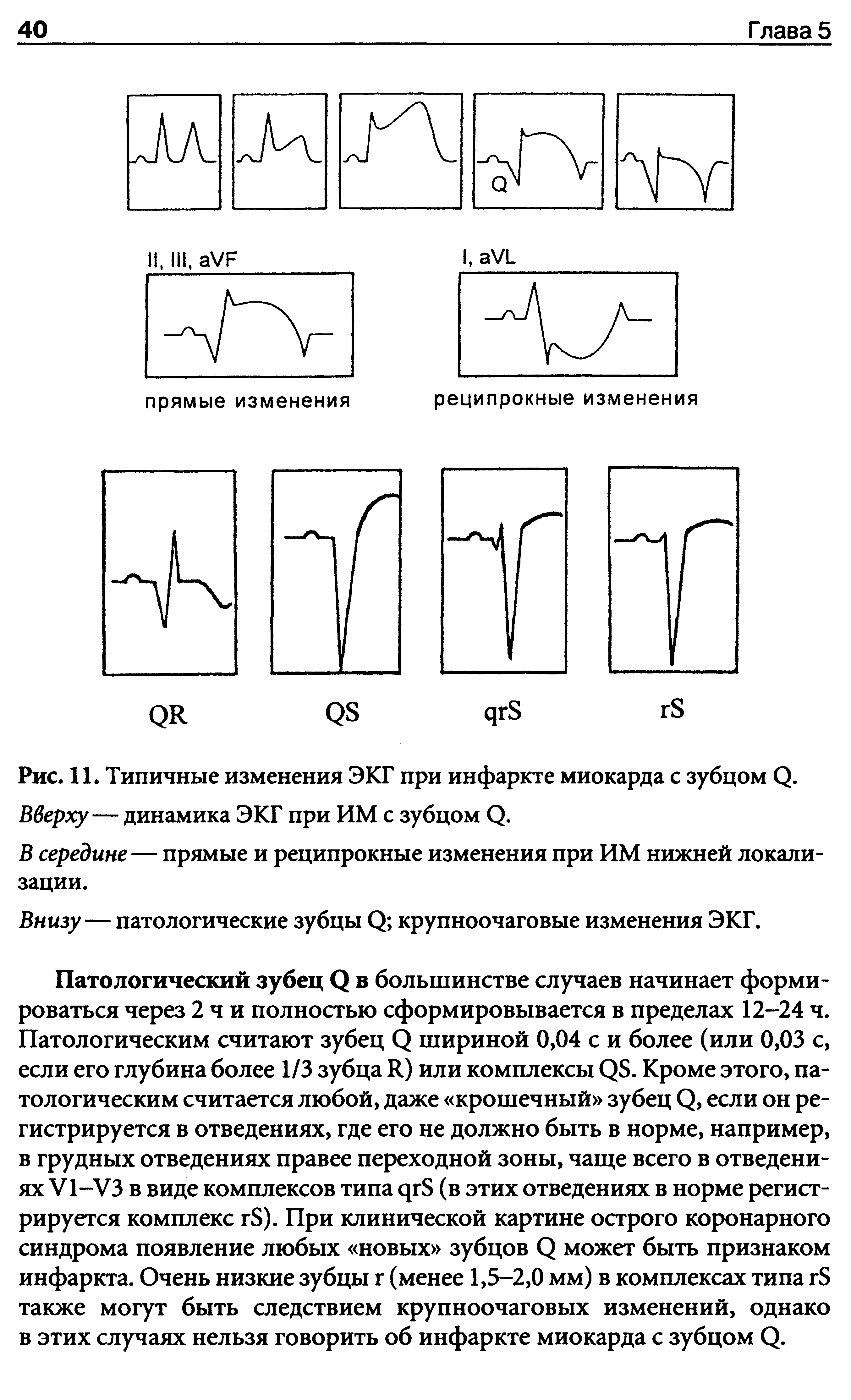 Рис. 11. Типичные изменения ЭКГ при инфаркте миокарда с зубцом (2. Вверху—динамика ЭКГ при ИМ с зубцом О.