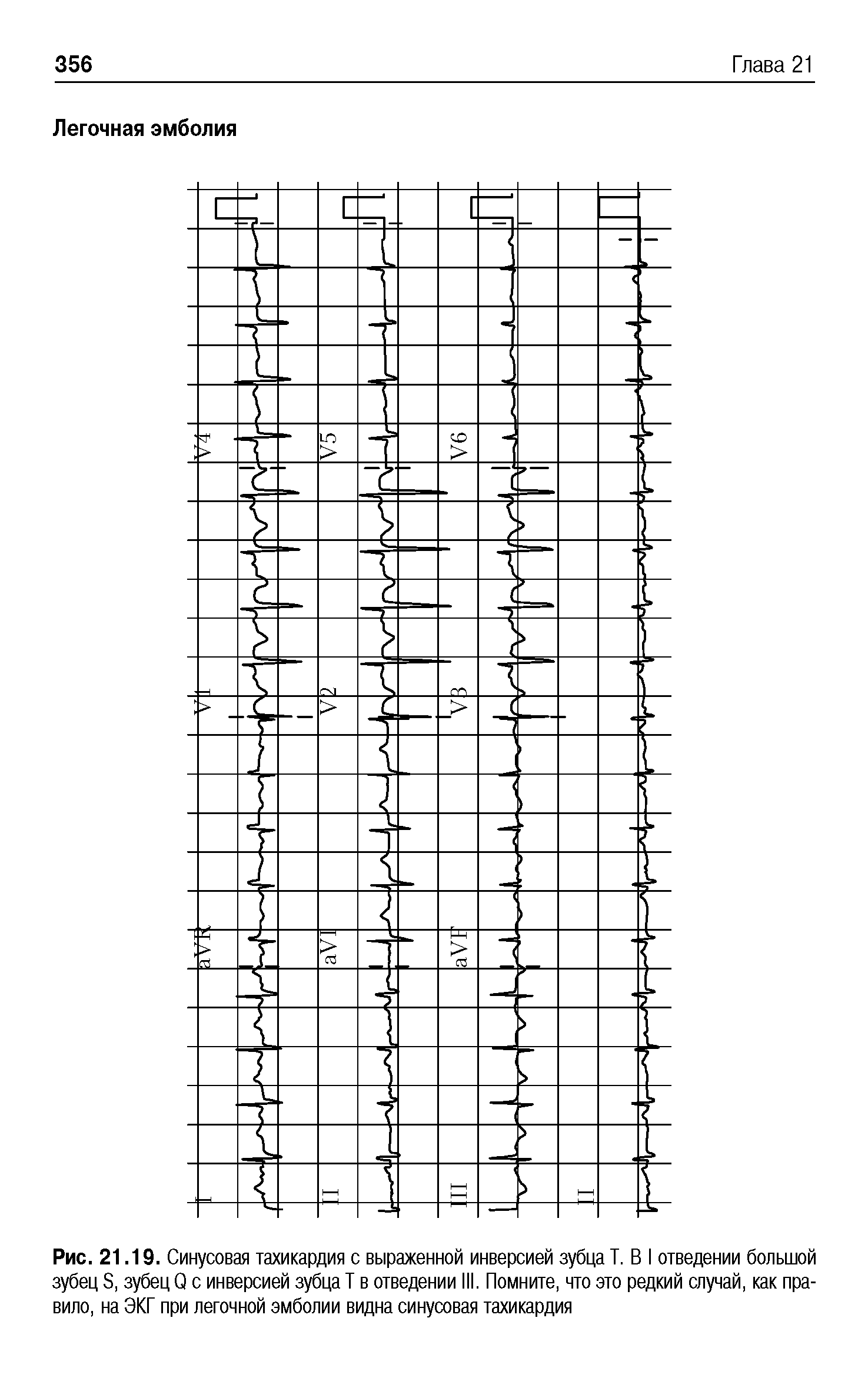 Рис. 21.19. Синусовая тахикардия с выраженной инверсией зубца Т. В I отведении большой зубец S, зубец Q с инверсией зубца Т в отведении III. Помните, что это редкий случай, как правило, на ЭКГ при легочной эмболии видна синусовая тахикардия...