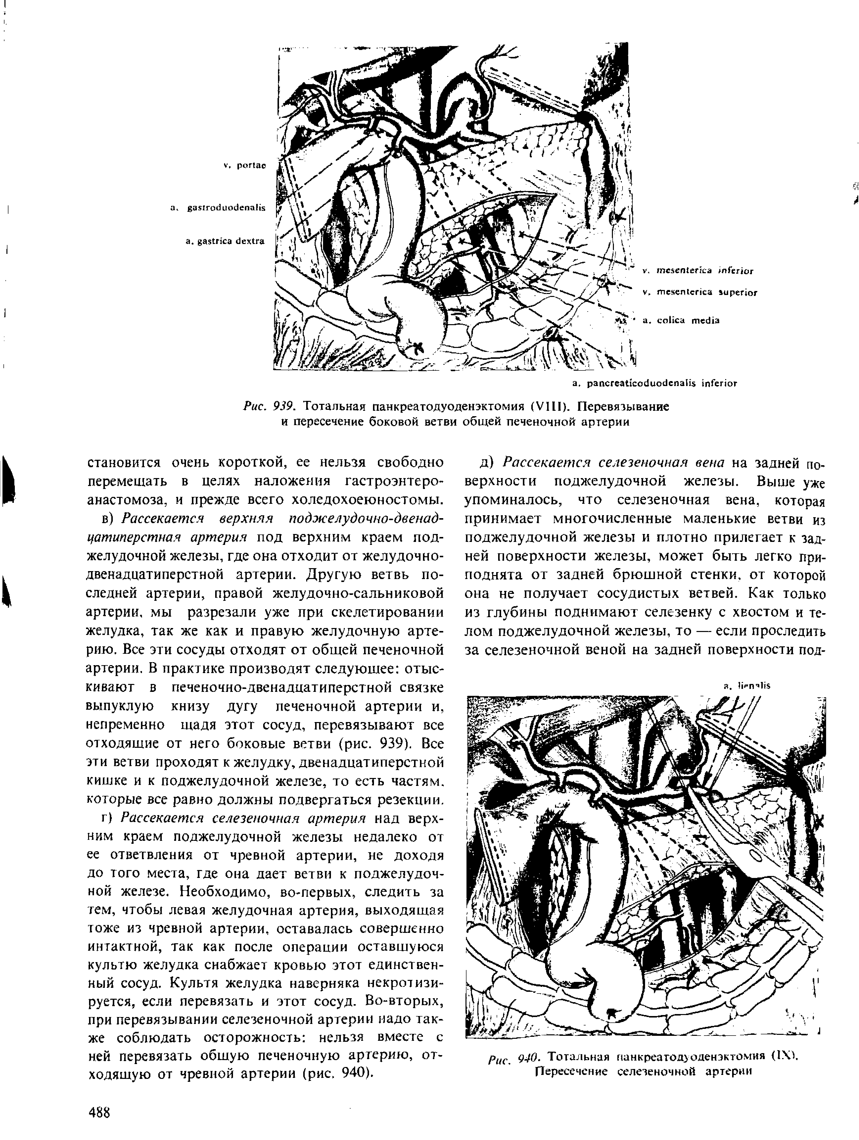 Рис. 939. Тотальная панкреатодуоденэктомия (VIII). Перевязывание и пересечение боковой ветви общей печеночной артерии...